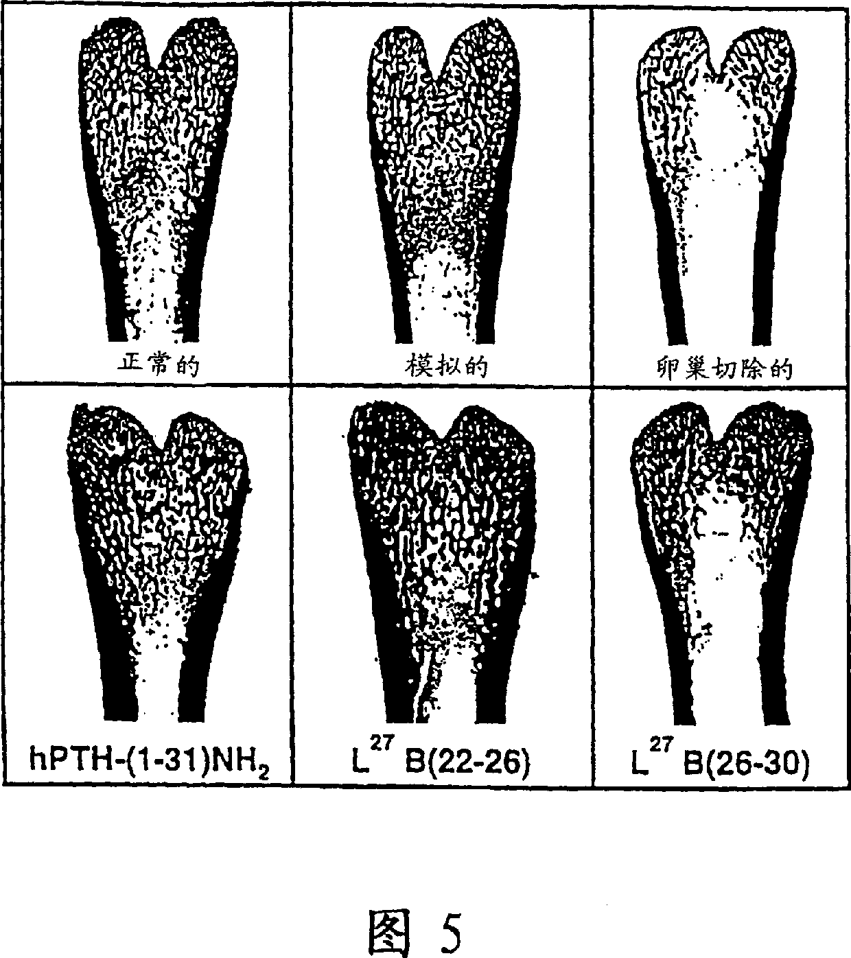 Parathyroid hormone analogues for the treatment of osteoporosis