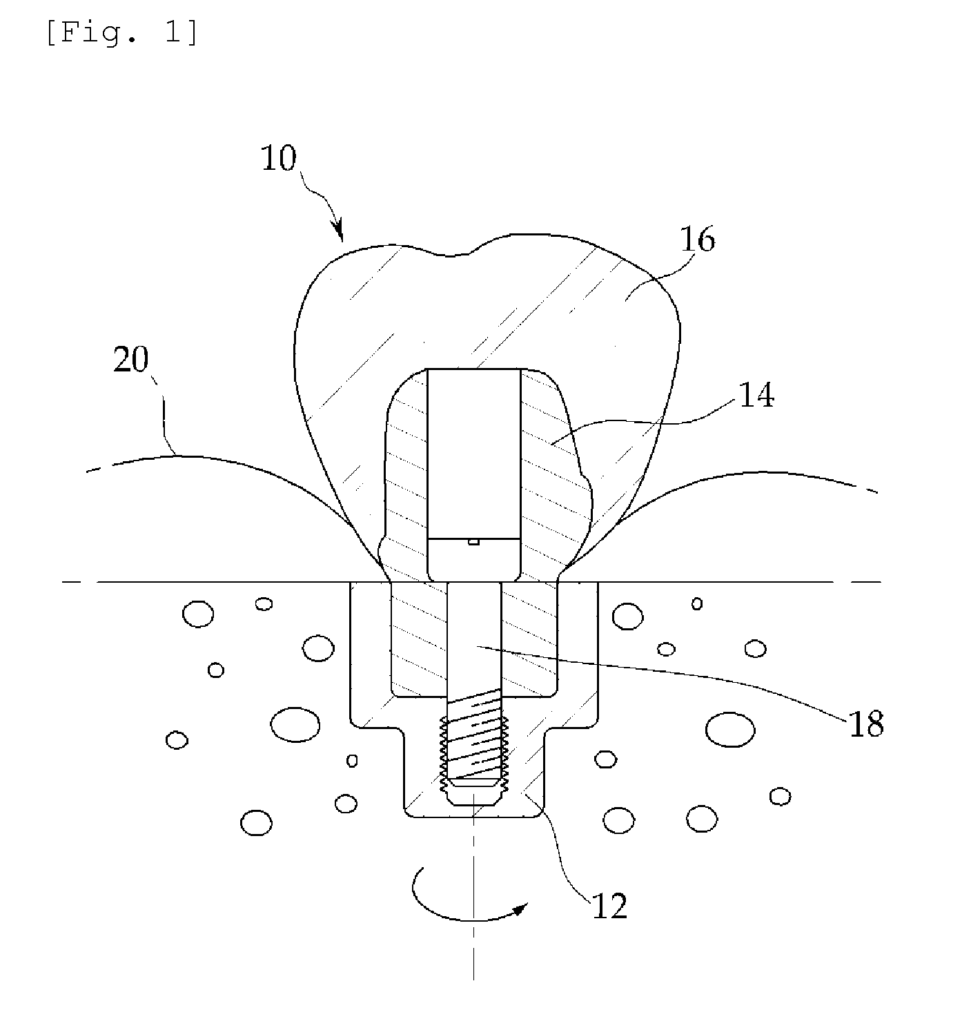 Implant abutment material for tailor-made and method for manufacturing abutment using the same