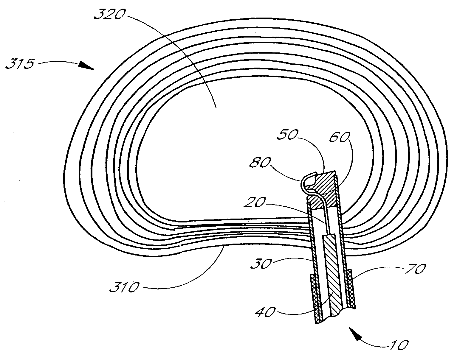 Apparatus delivery in an intervertebral disc