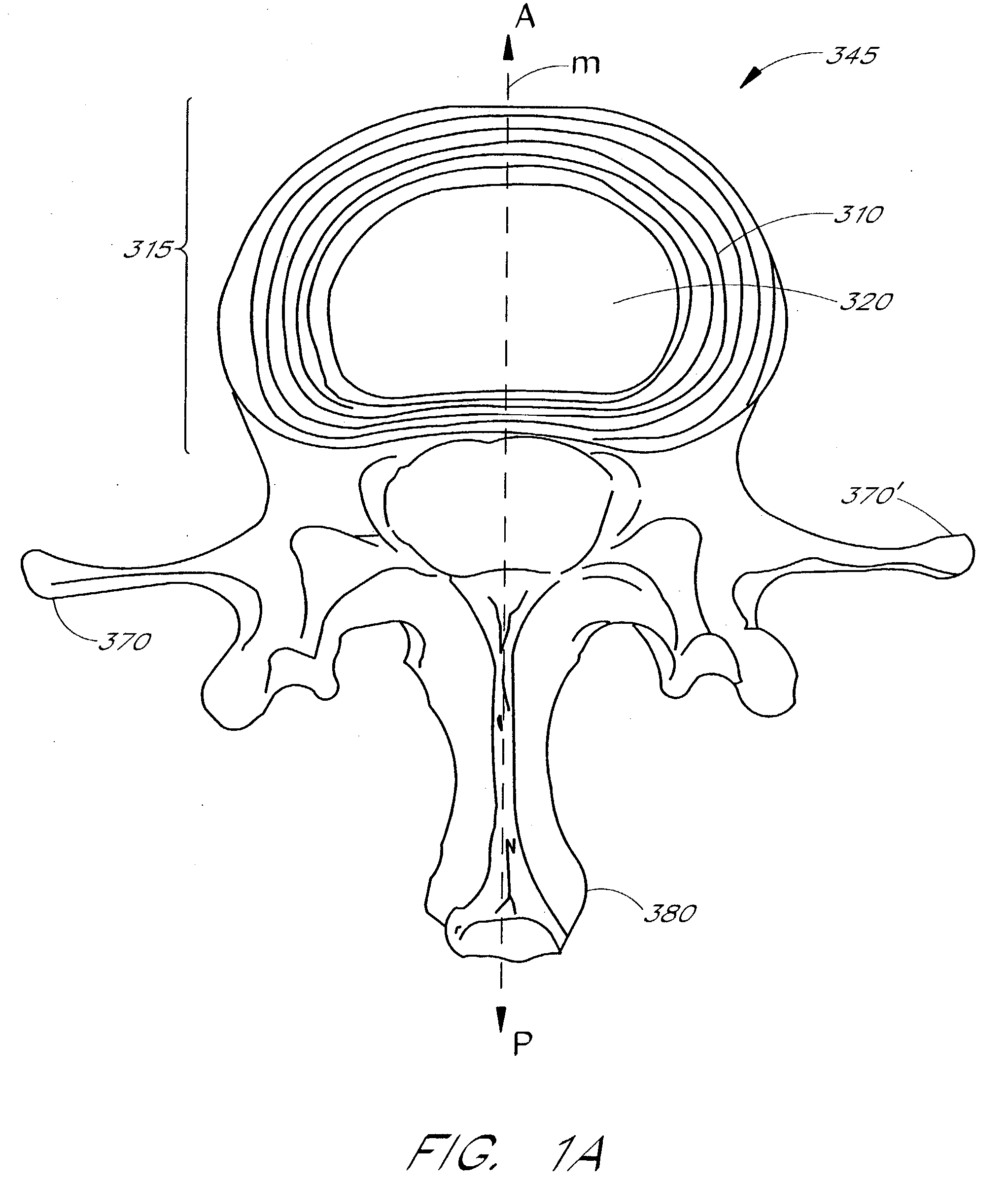 Apparatus delivery in an intervertebral disc