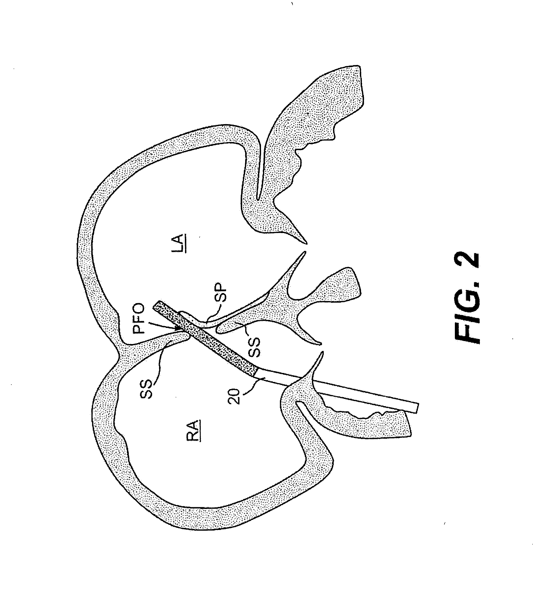 Closure devices, related delivery methods and tools, and related methods of use