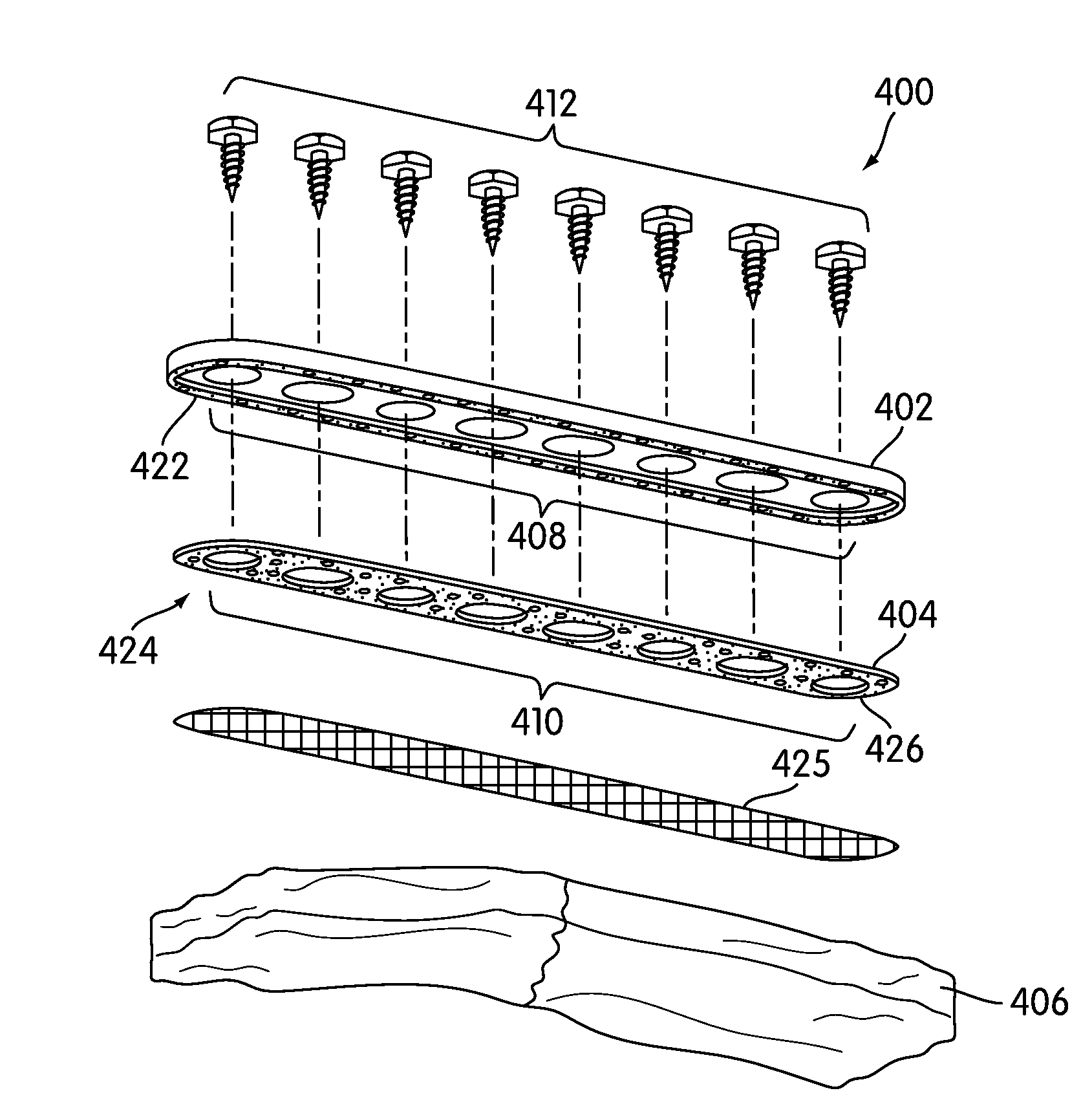 Spinal Fusion Implants with Selectively Applied Bone Growth Promoting Agent