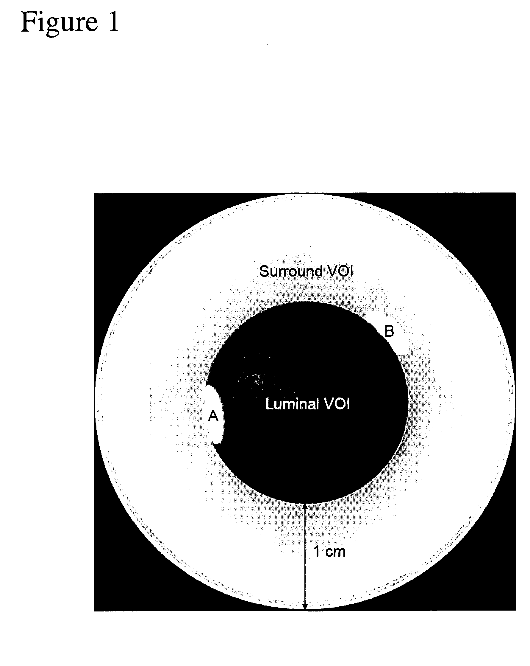 Quantification method of vessel calcification