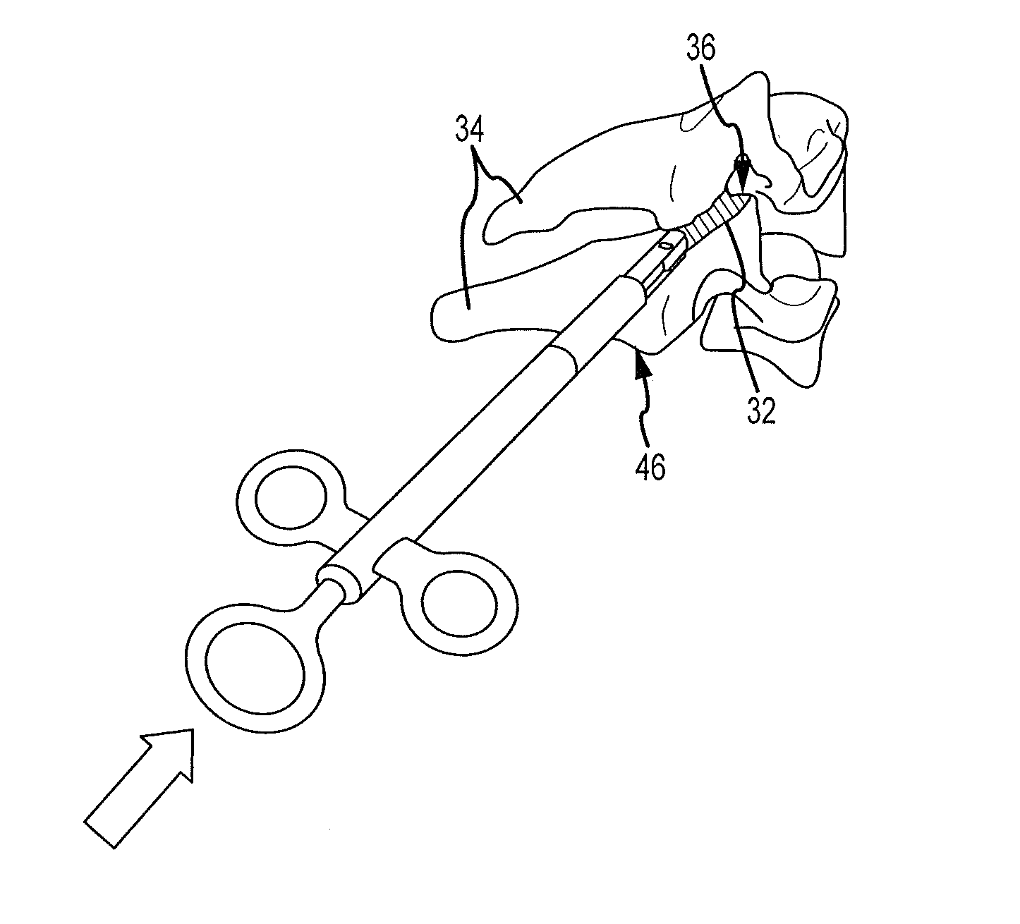 Cervical distraction/implant delivery device
