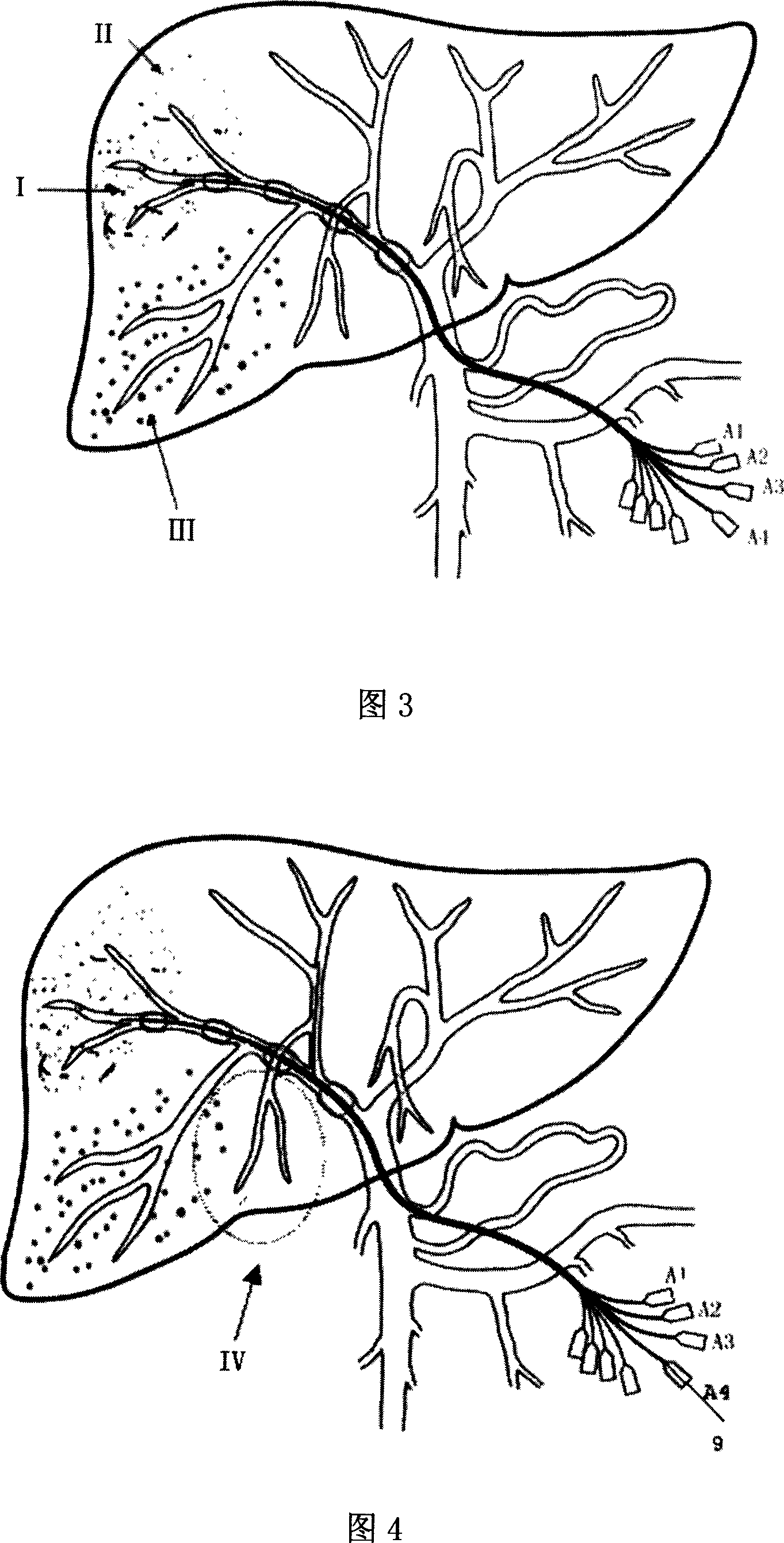 Liver segment positioning catheter