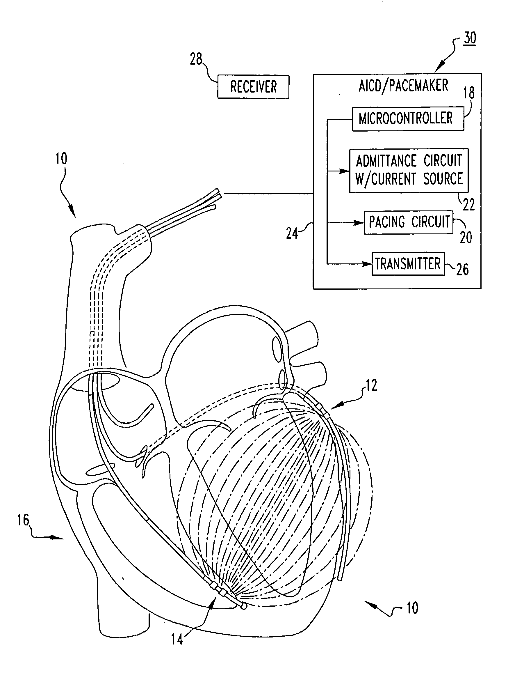 Admittance measurement for tuning bi-ventricular pacemakers