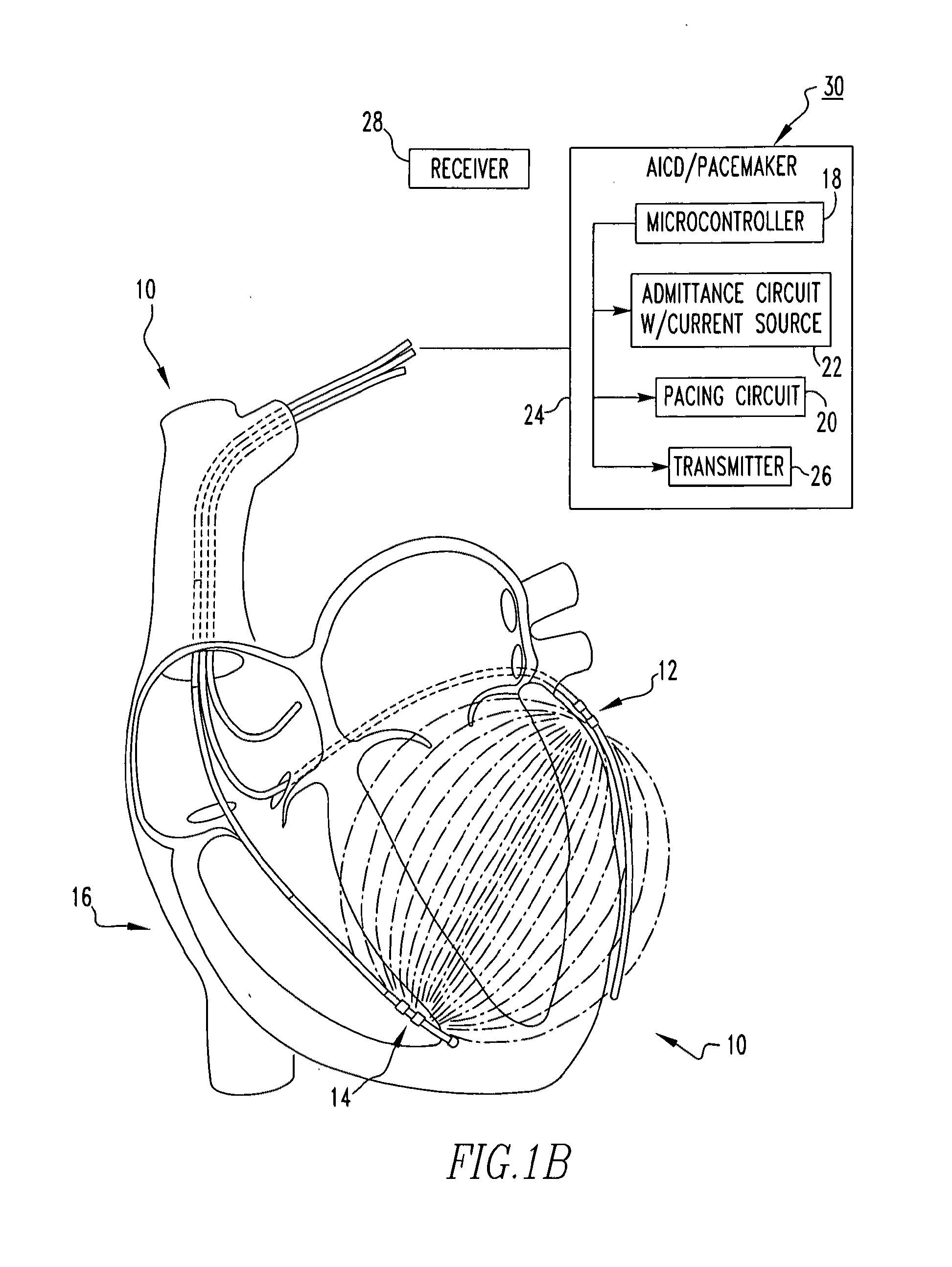 Admittance measurement for tuning bi-ventricular pacemakers