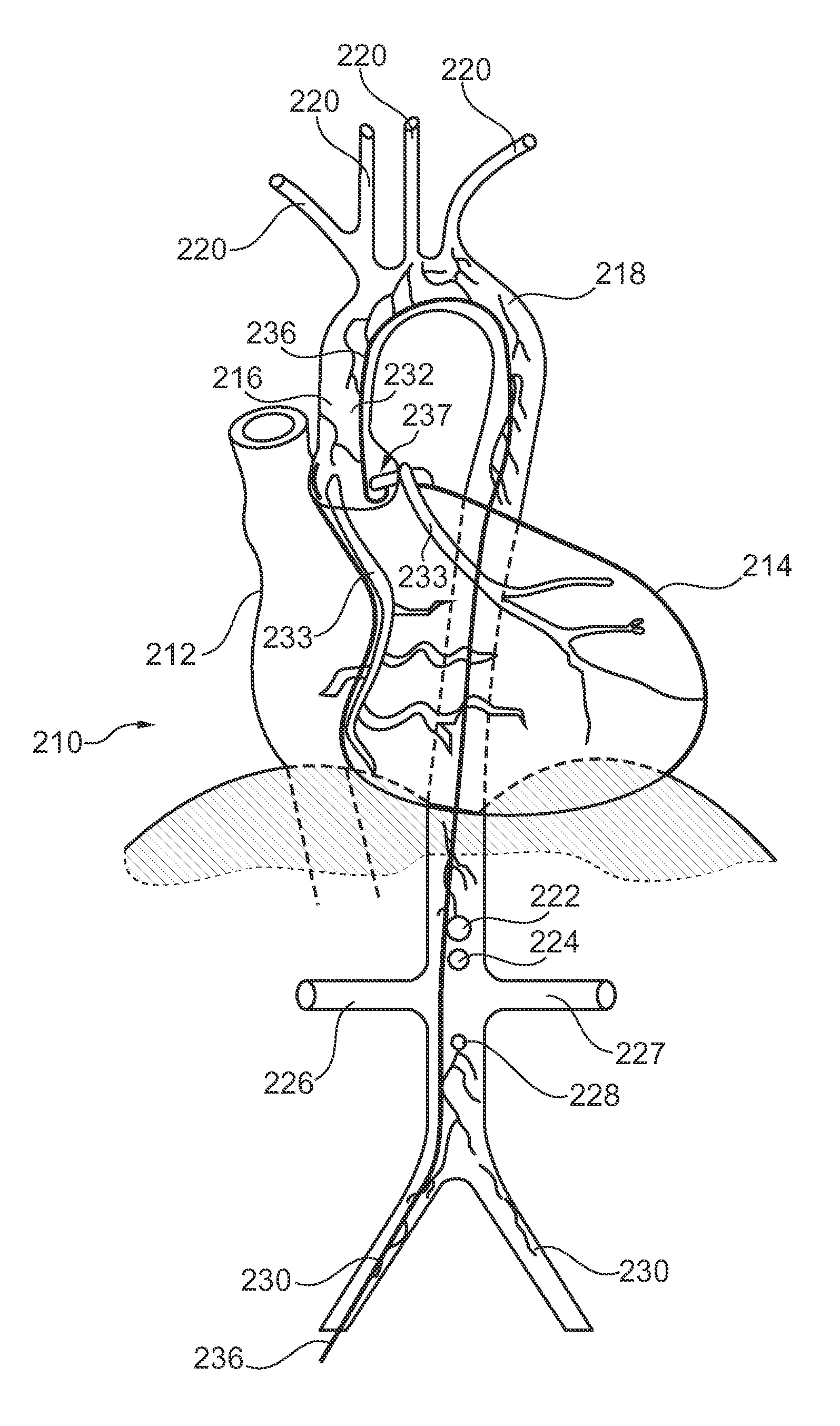 Image representation supporting the accurate positioning of an intervention device in vessel intervention procedures