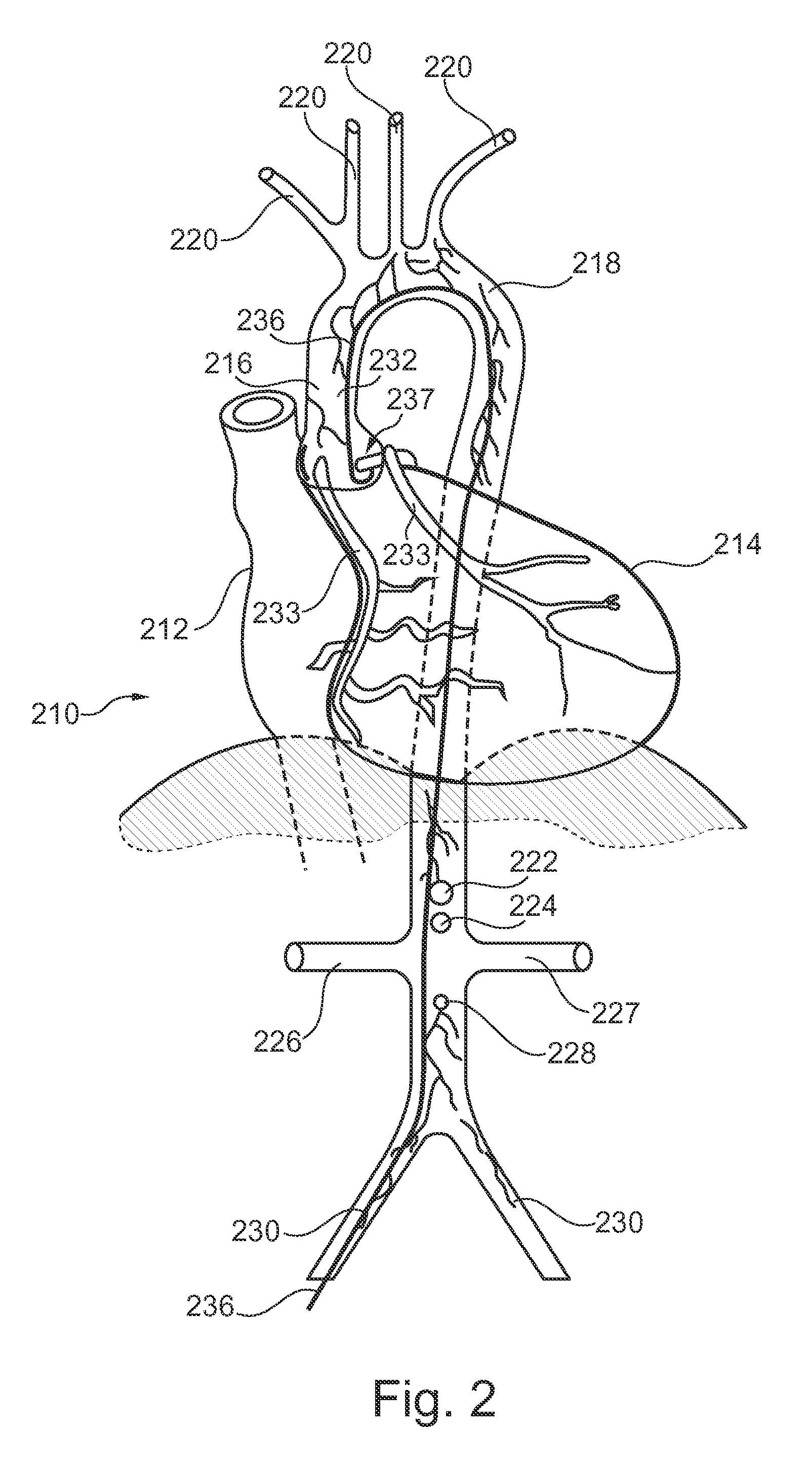Image representation supporting the accurate positioning of an intervention device in vessel intervention procedures