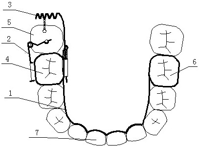 Anterior tilting molar erector with two-way force system