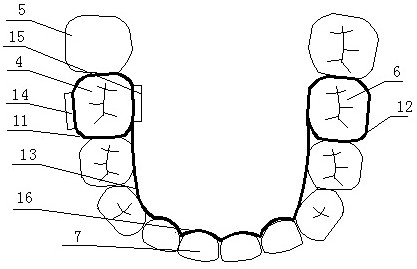 Anterior tilting molar erector with two-way force system