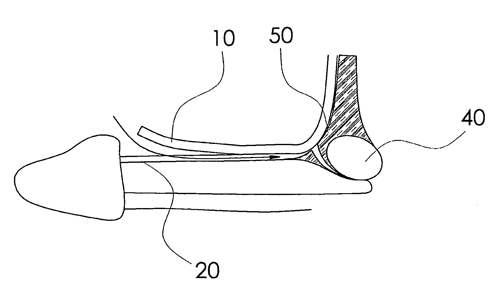 Method for complex phalloplasty with minimal incision