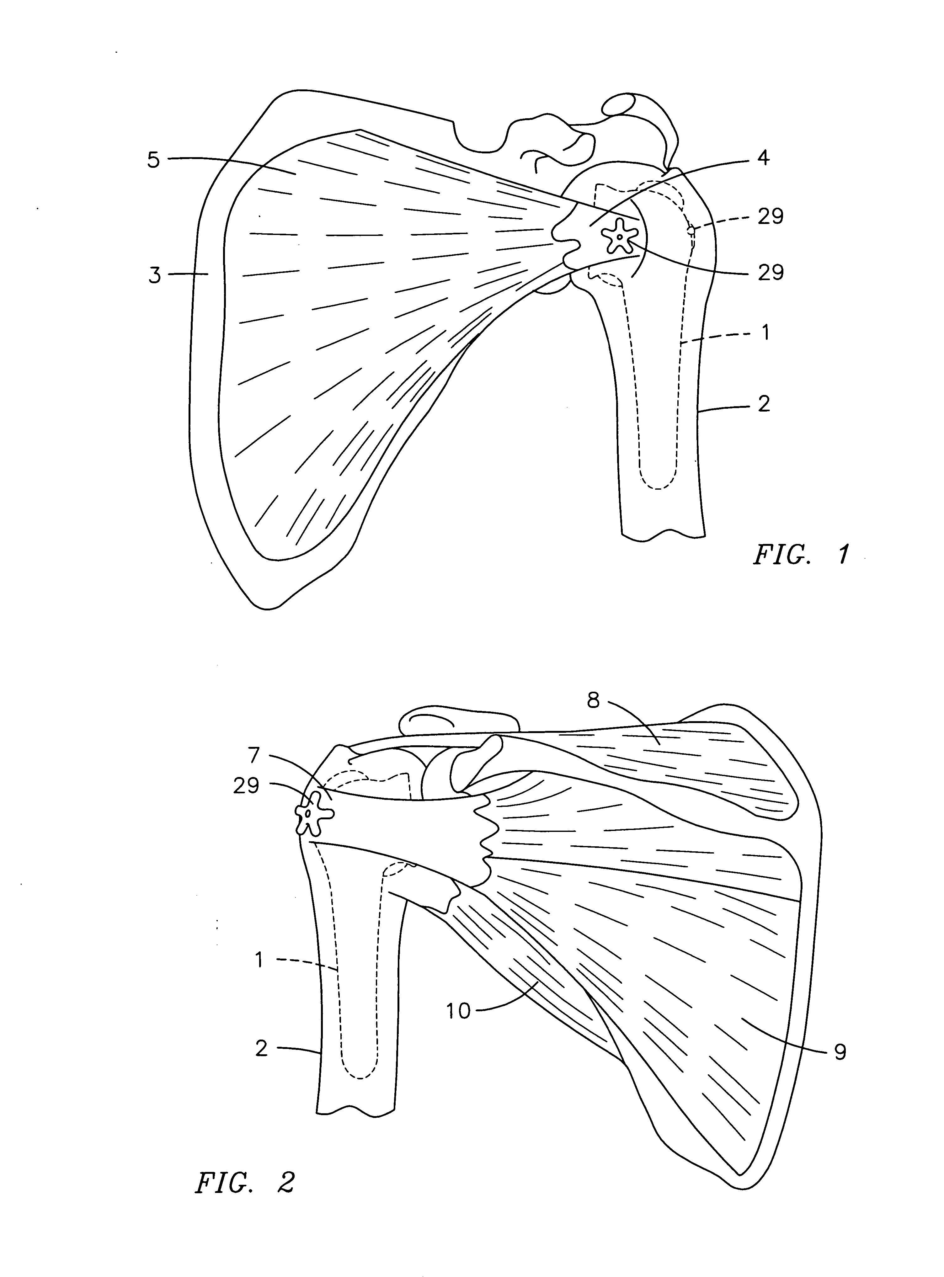 Prosthetic humeral device and method