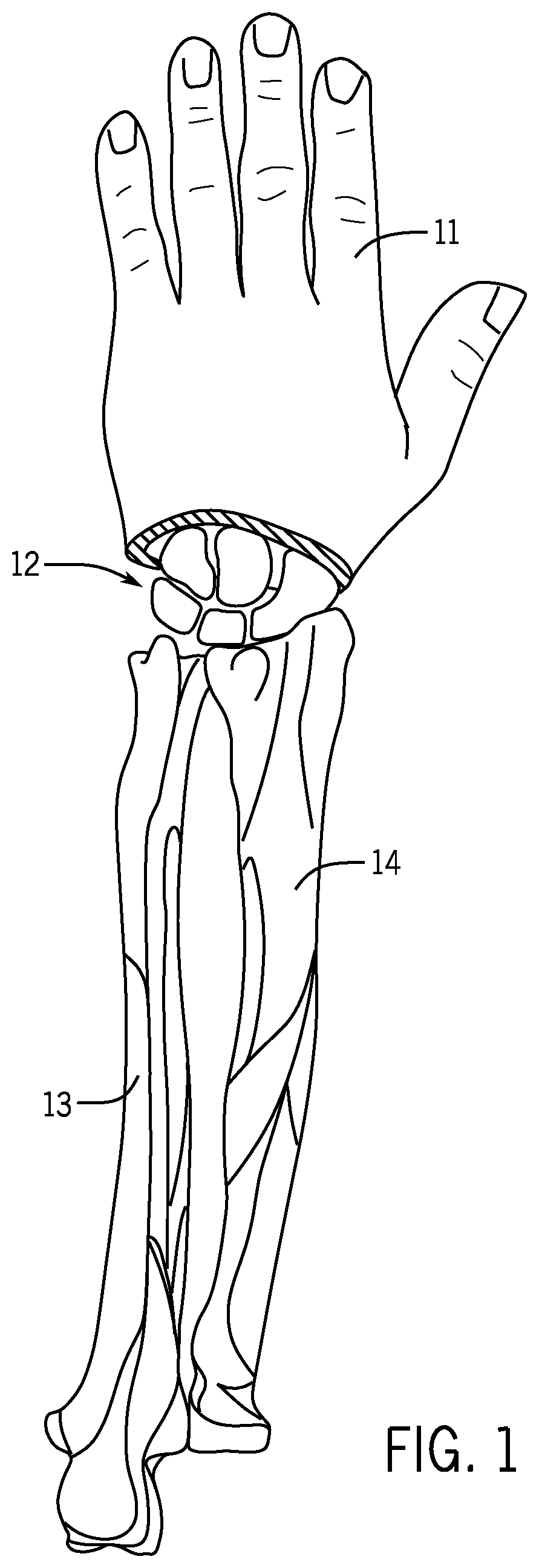 Fracture fixation device having clip for stabilizing intramedullary nail