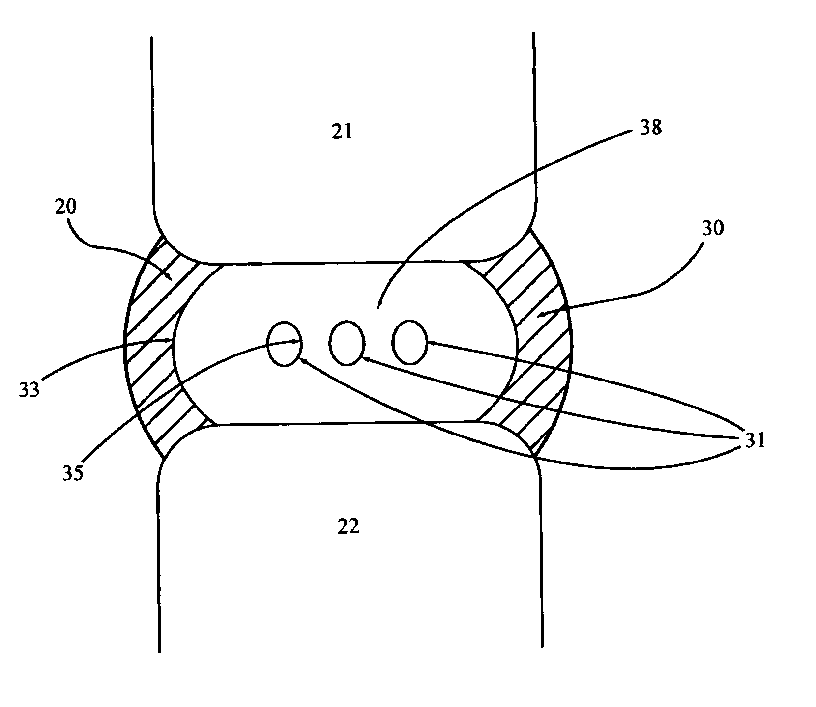 Spinal disc implants with reservoirs for delivery of therapeutic agents