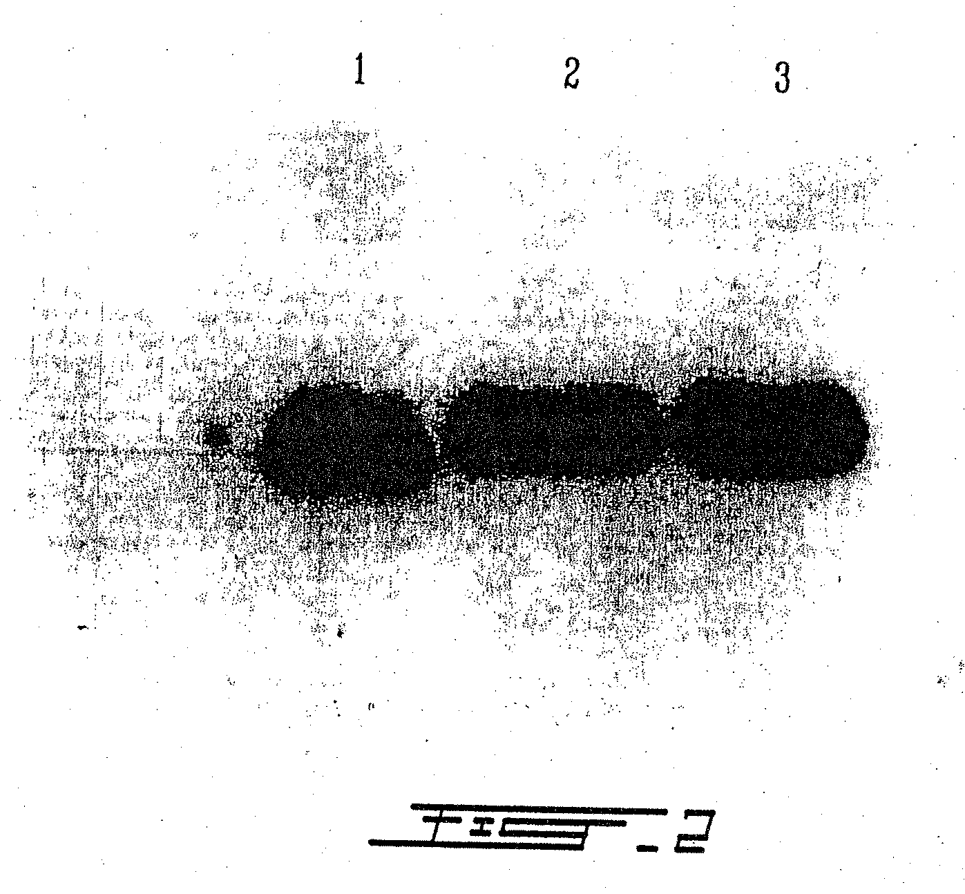 Treatment of macular degeneration with ADP-ribosyl transferase fusion protein therapeutic compositions