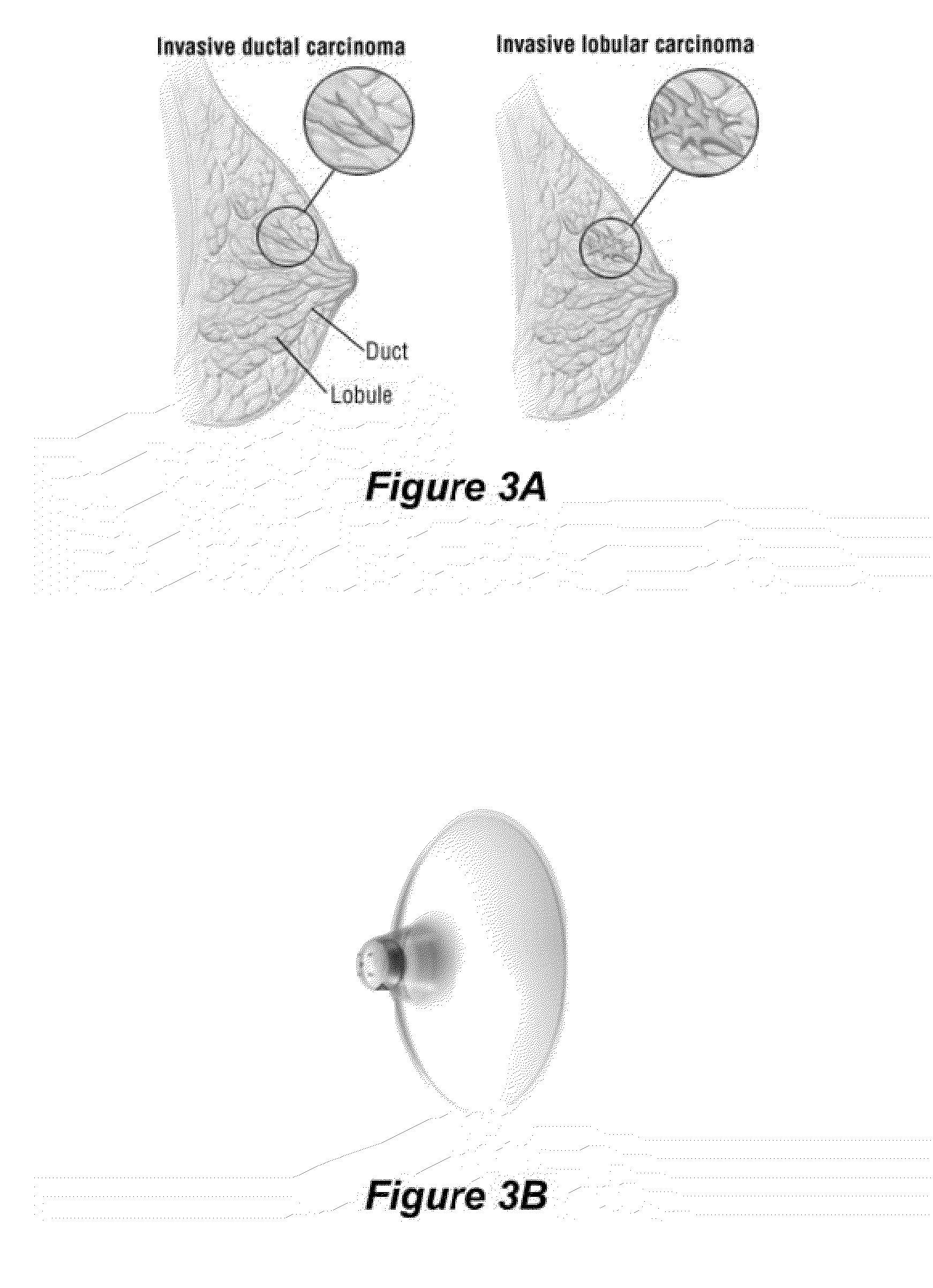 Compositions and methods for localized drug delivery through mammary papillae