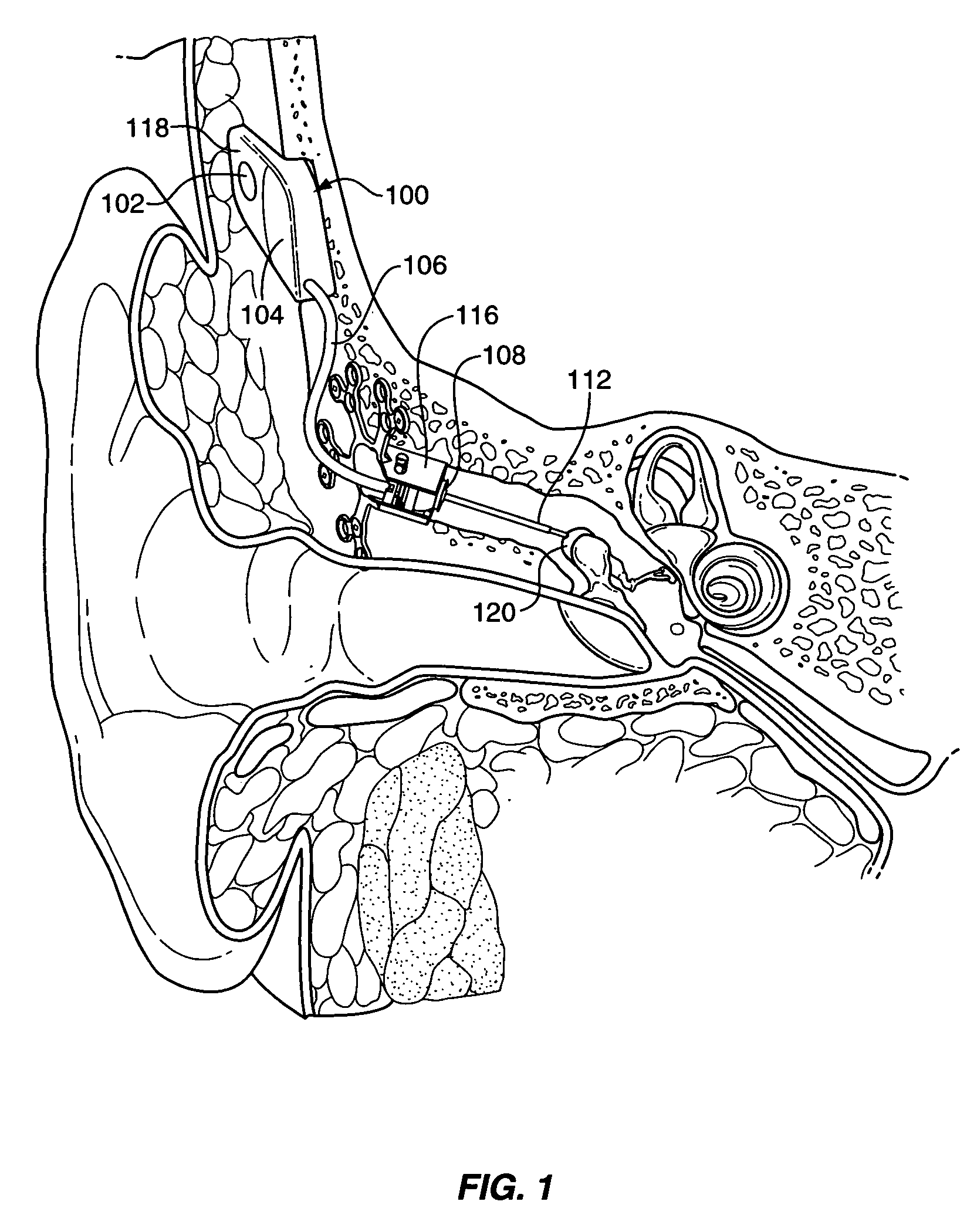 Implantable hearing aid transducer retention apparatus