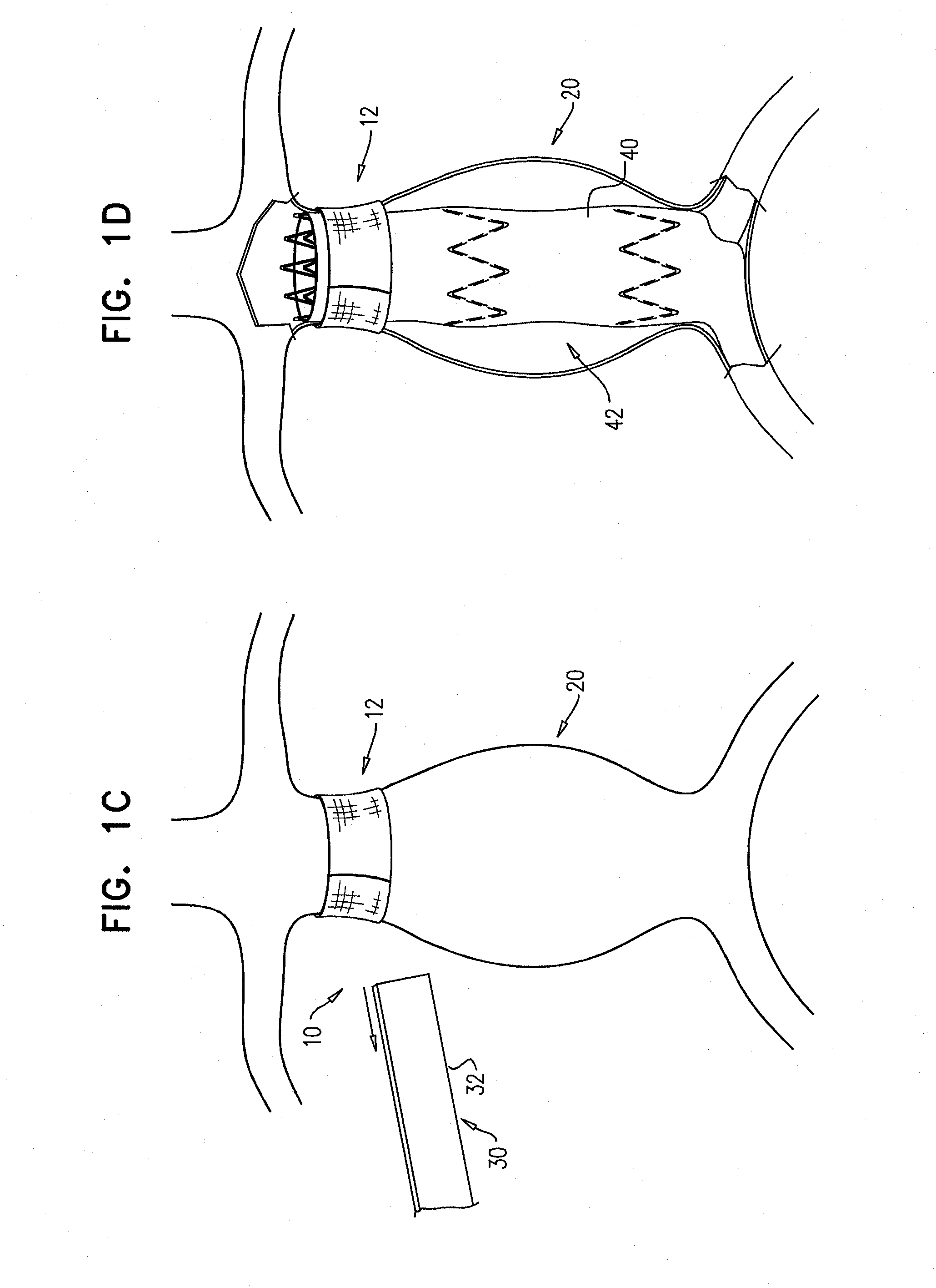 Vascular bands and delivery systems therefor