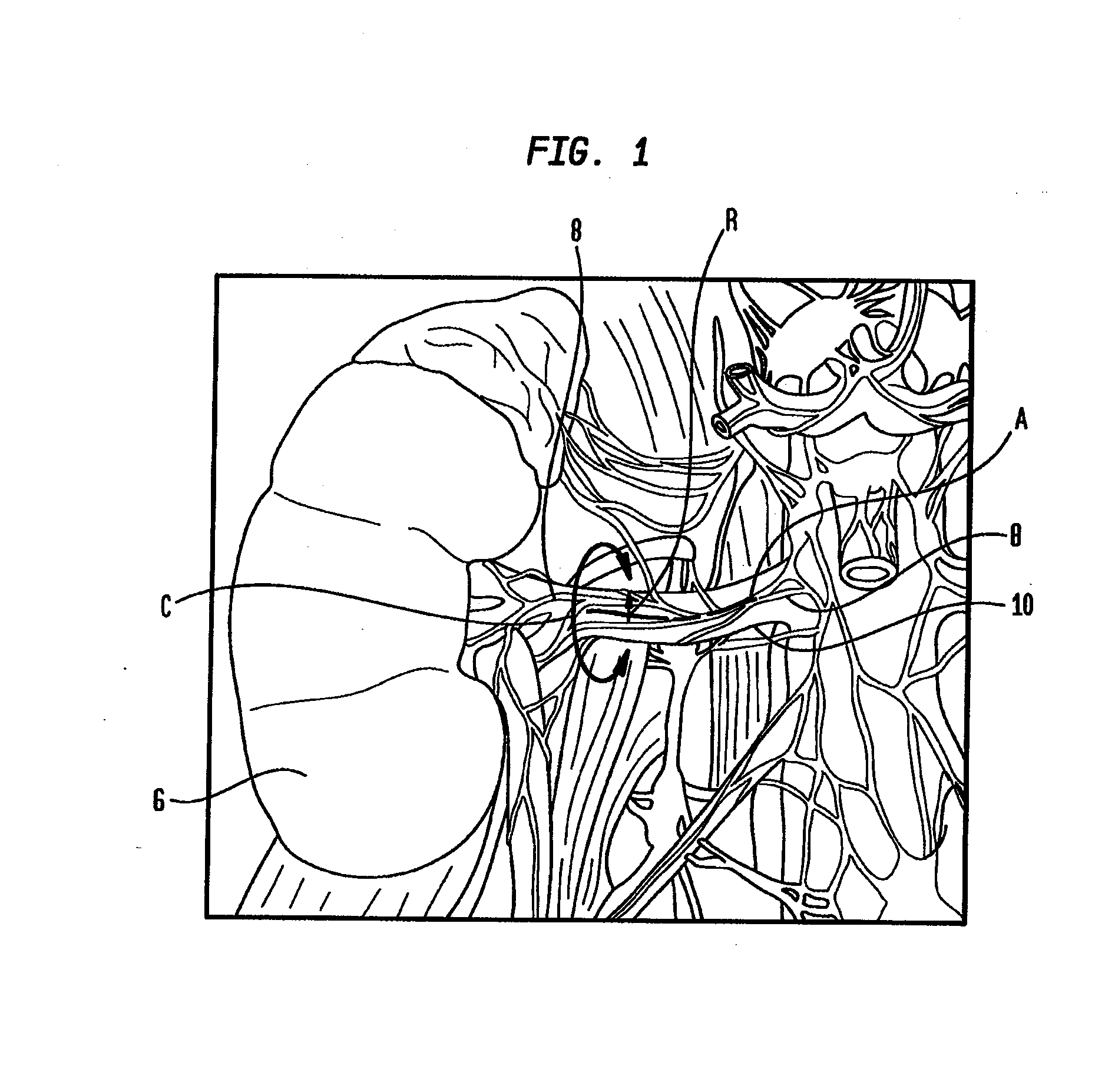 Method and Apparatus for Treatment of Hypertension Through Percutaneous Ultrasound Renal Denervation