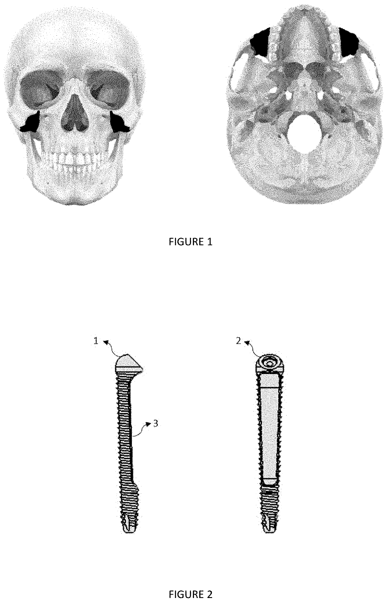 Medical implant and medical implant system for malar process of the maxilla