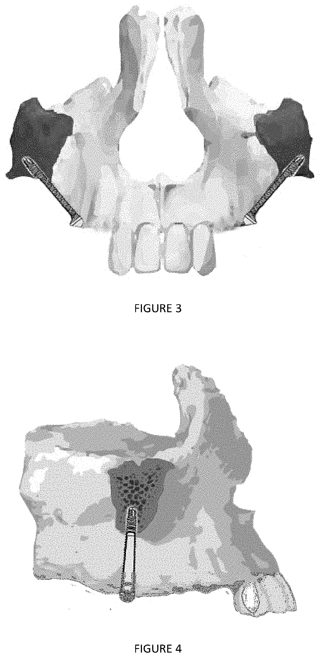 Medical implant and medical implant system for malar process of the maxilla