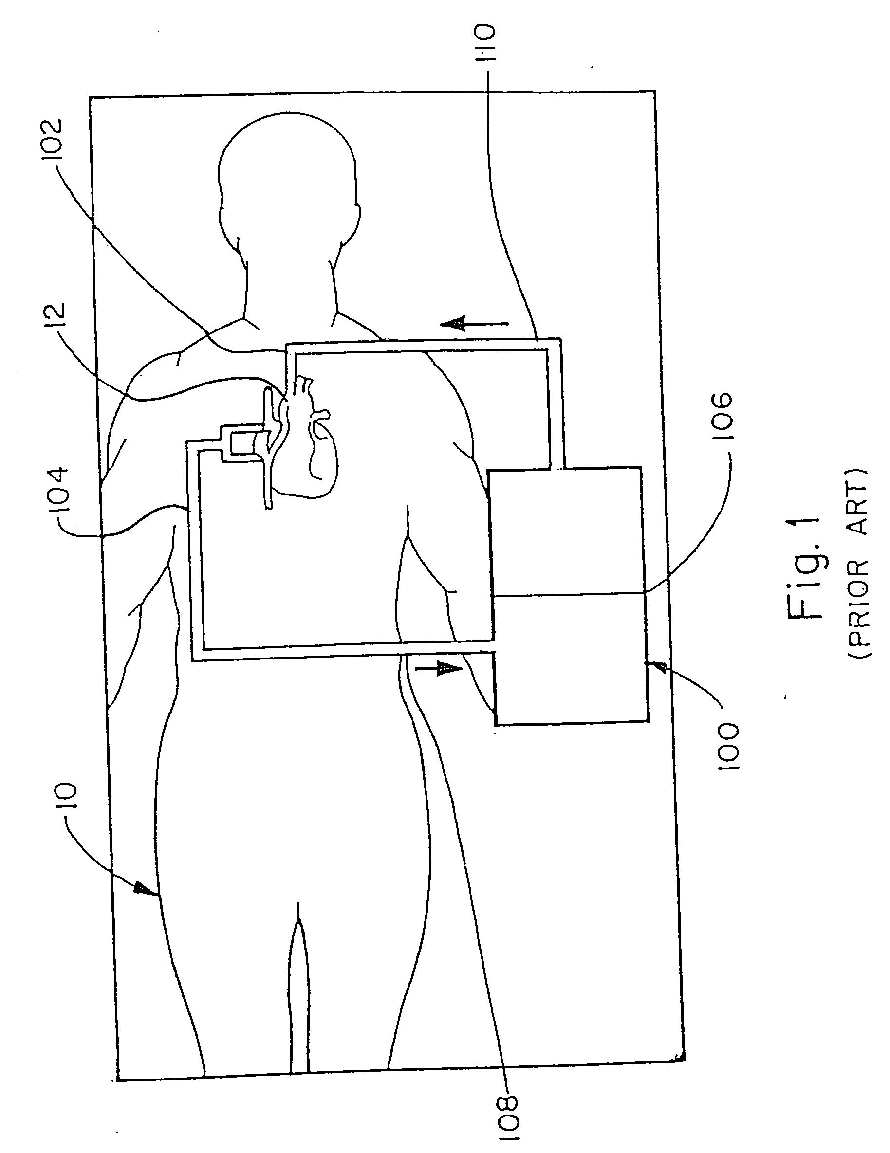 Method of recovering blood from an extracorporeal circuit