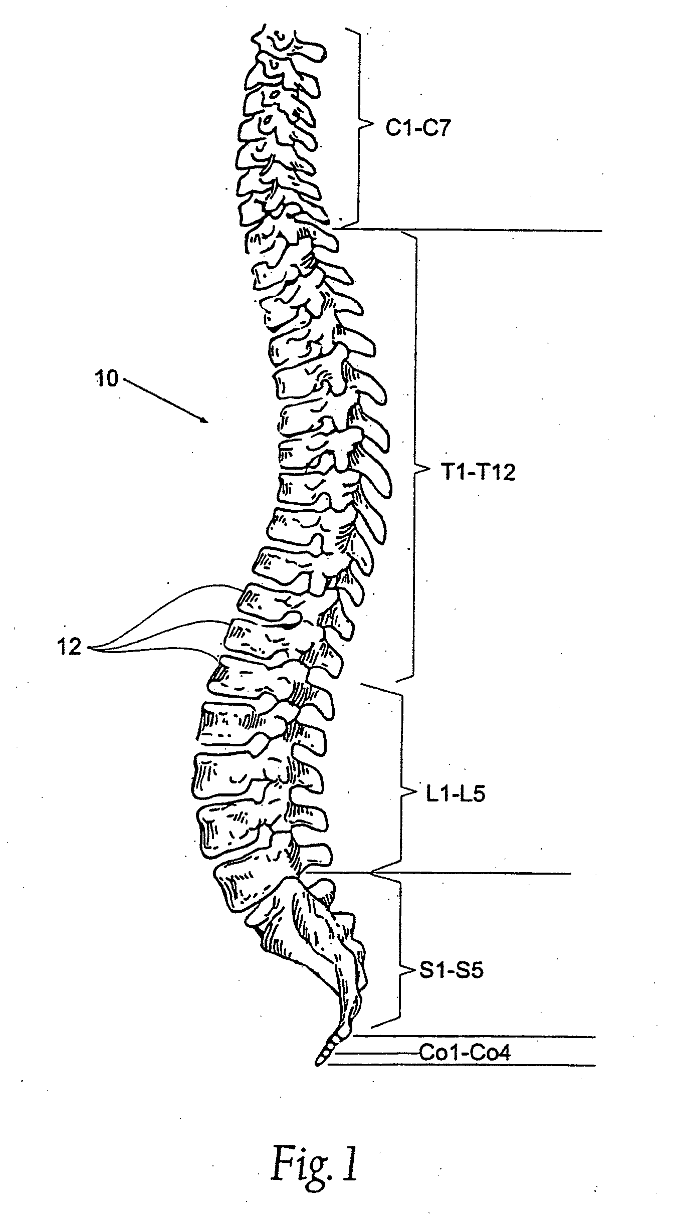 Prostheses systems and methods for replacement of natural facet joints with artificial facet joint surfaces