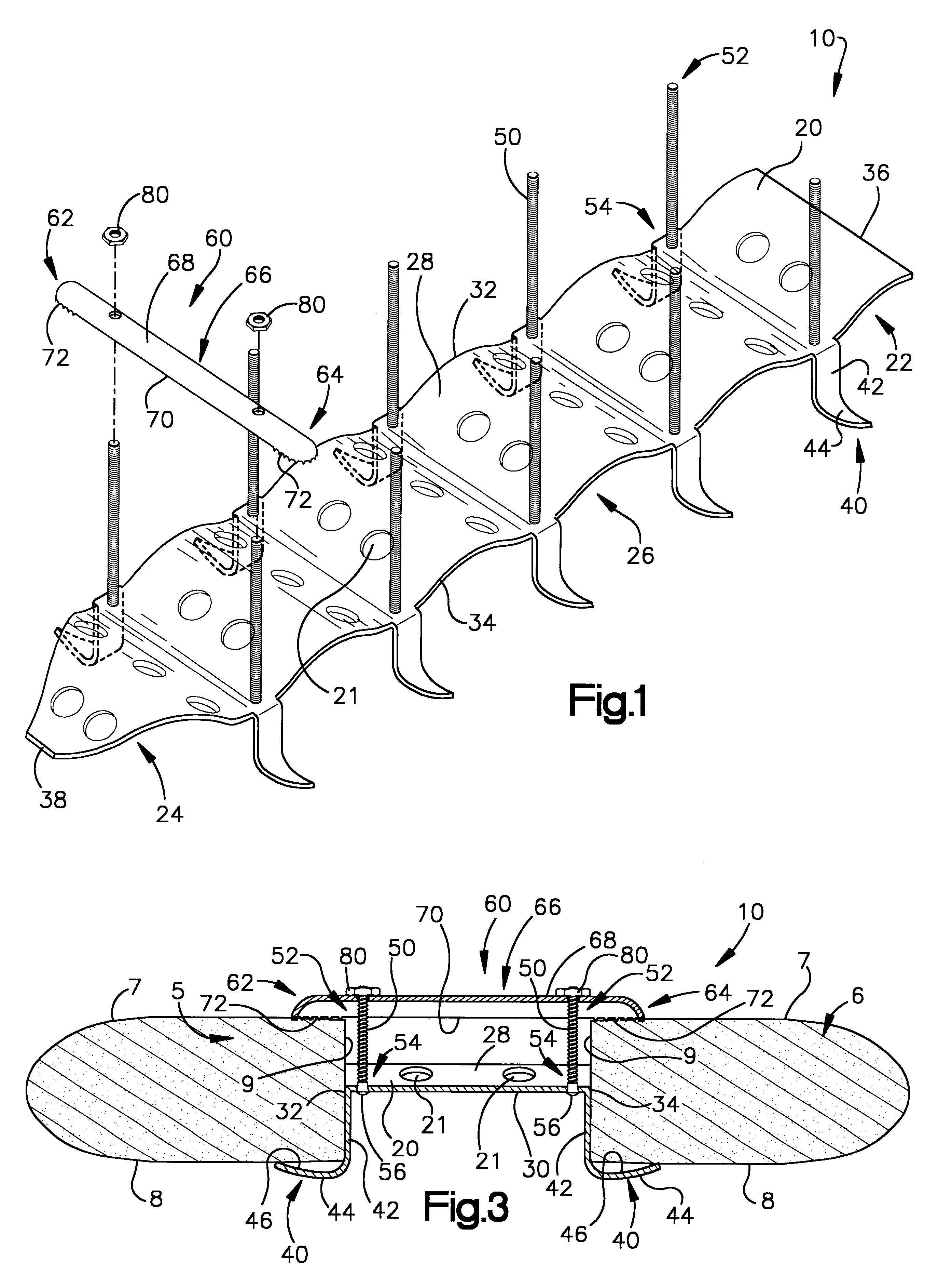 Sternum closure apparatus and method for helping maintain a space between parts of the sternum