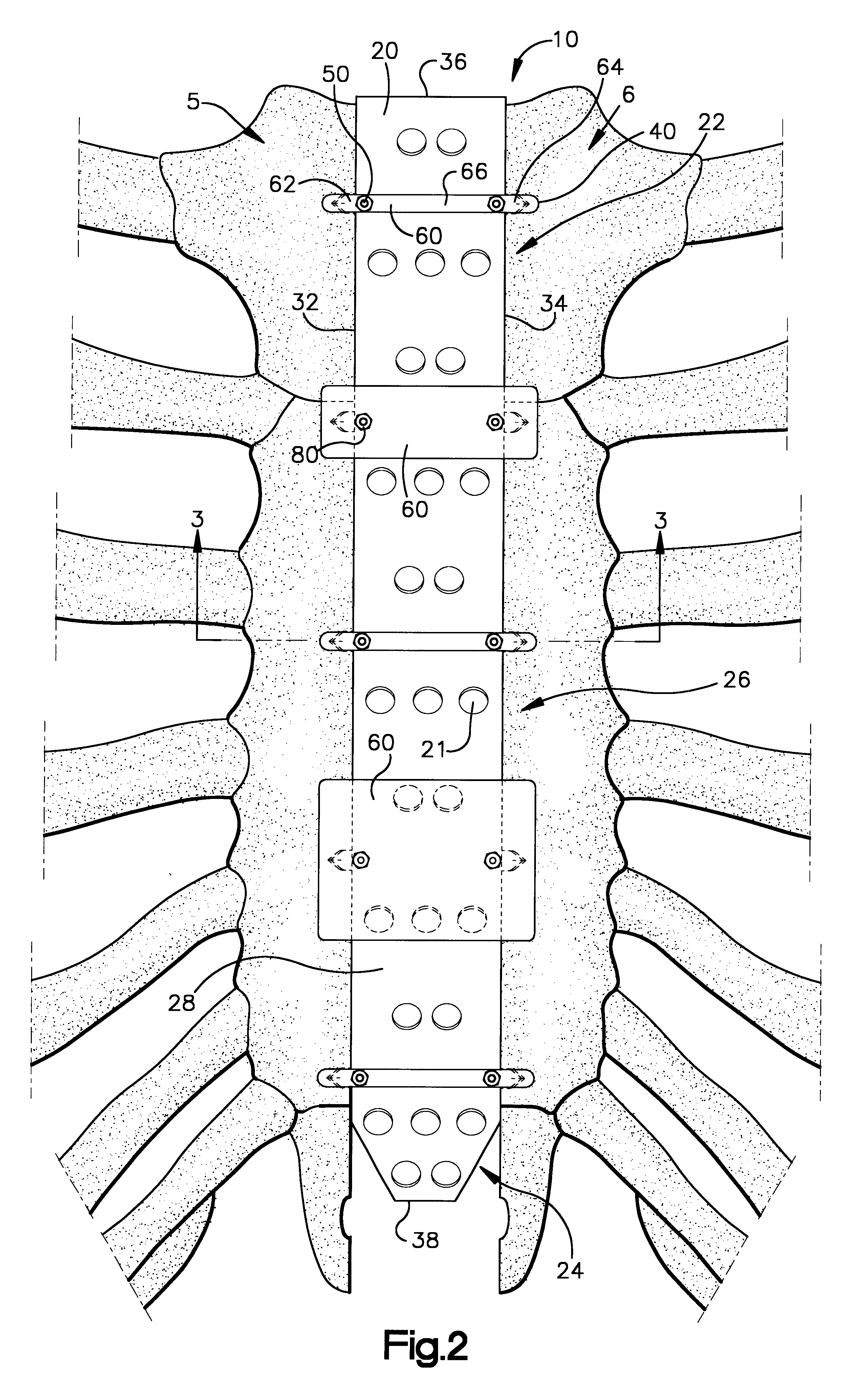 Sternum closure apparatus and method for helping maintain a space between parts of the sternum