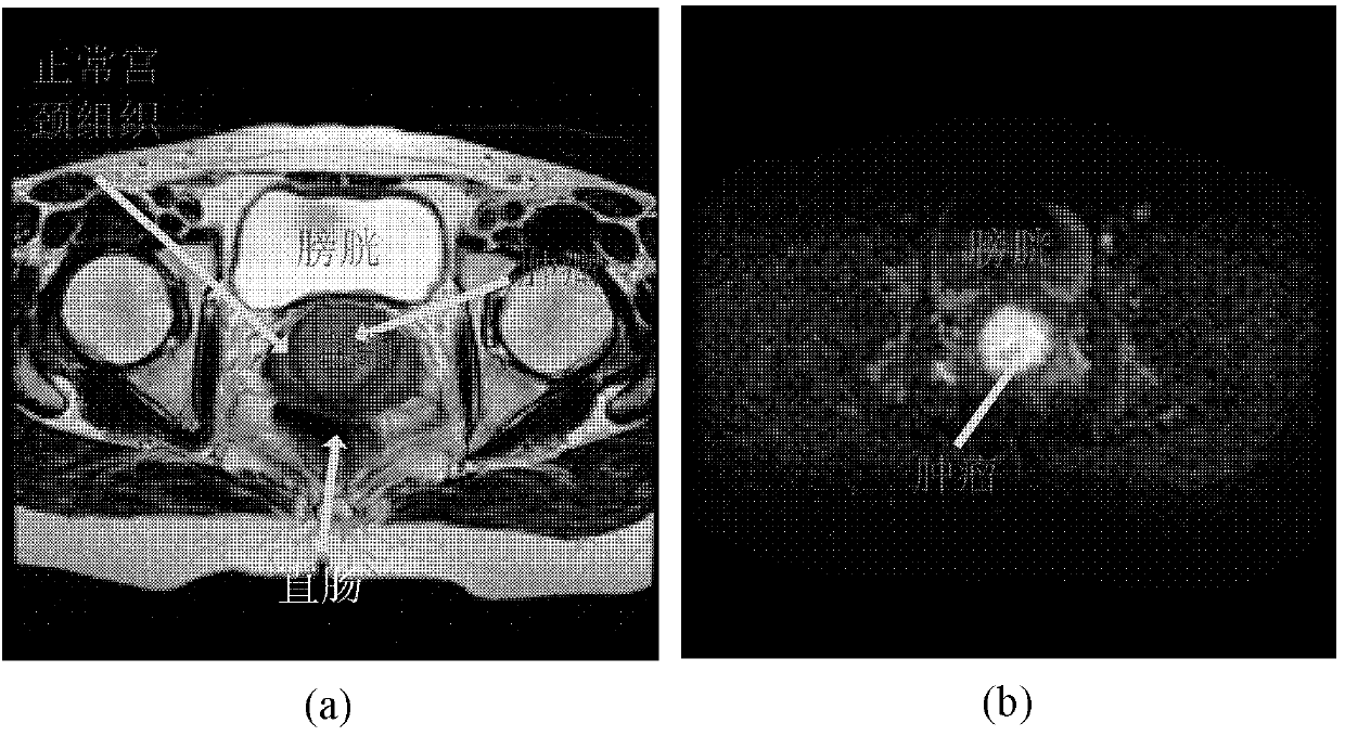 Cervical caner image automatic partition method based on T2-magnetic resonance imaging (MRI) and dispersion weighted (DW)-MRI