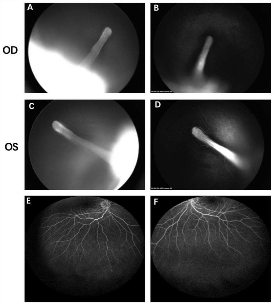 Primer for identifying familial exudative vitreoretinopathy with/without microhead deformity and application thereof