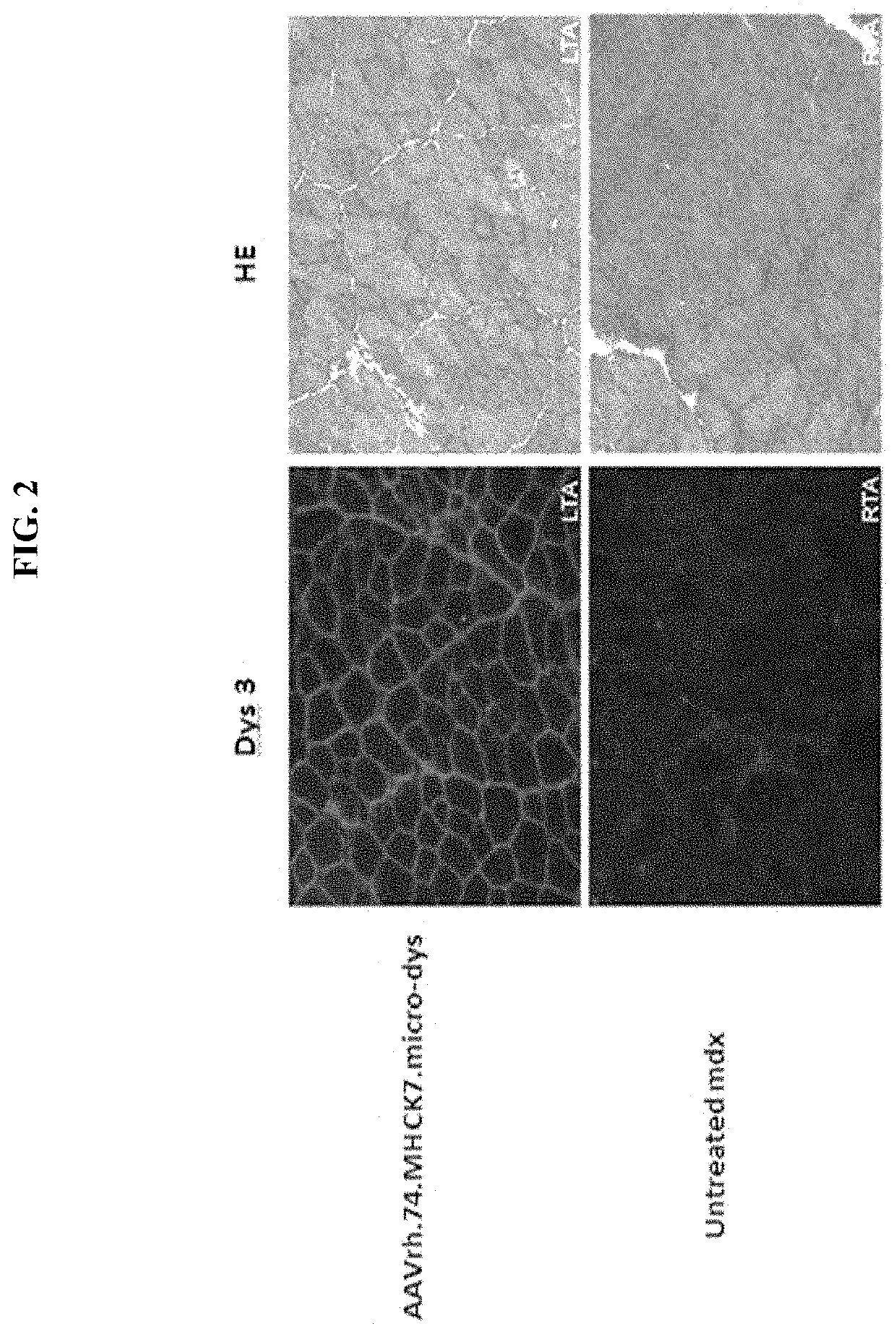 Adeno-Associated Virus Vector Delivery of Muscle Specific Micro-Dystrophin To Treat Muscular Dystrophy