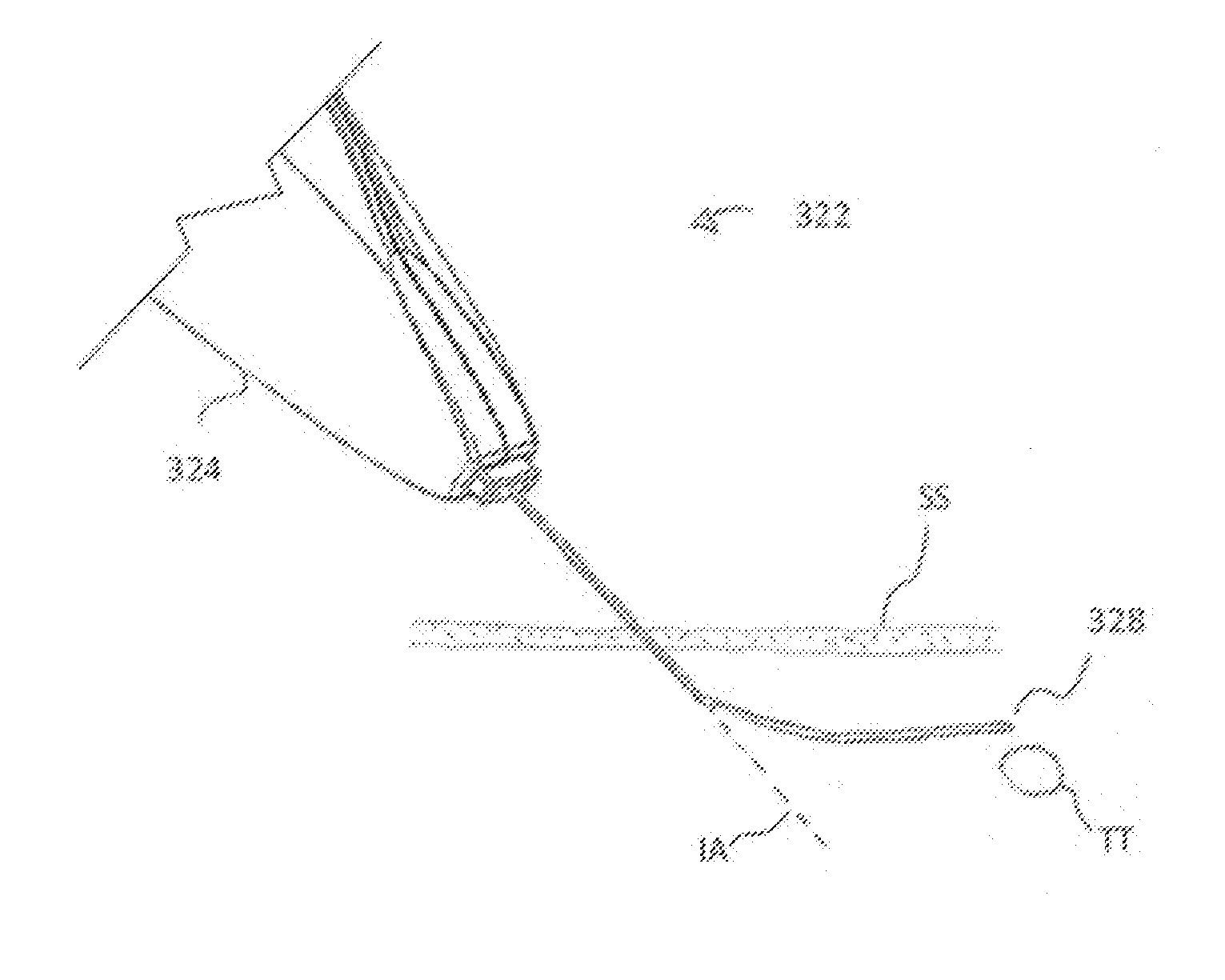 Methods and Systems for Preventing Neuroma Formations