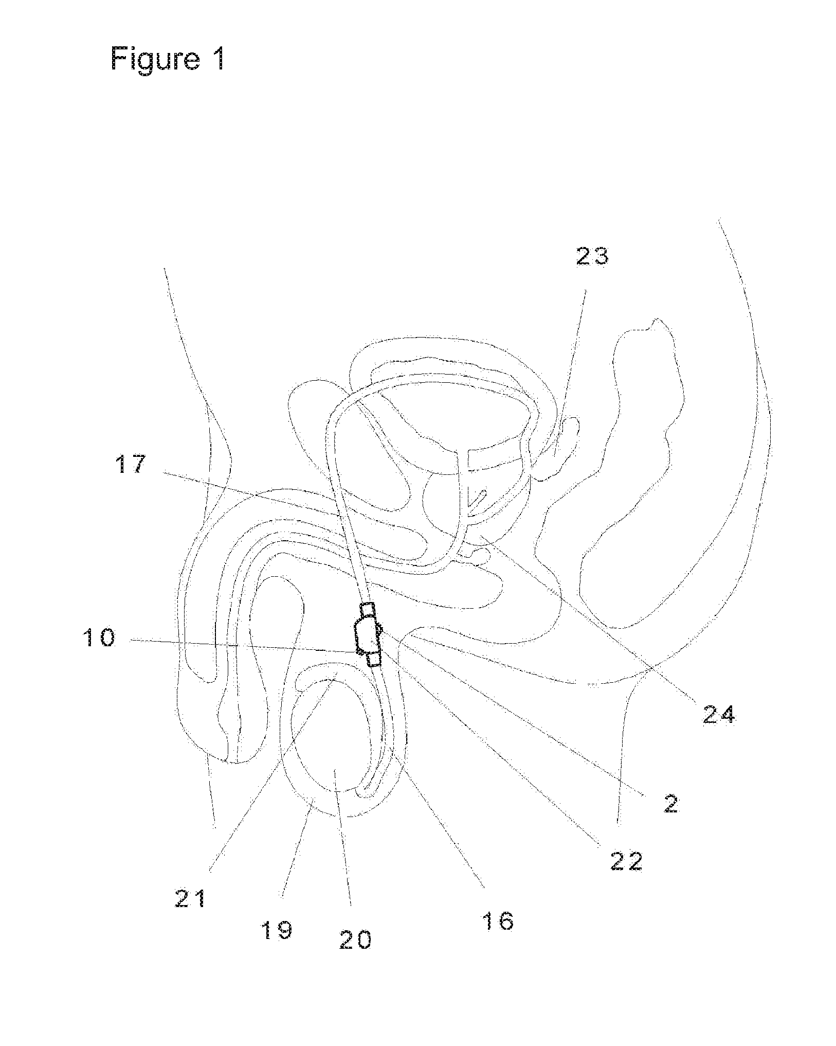 Device for contraception for use by a man
