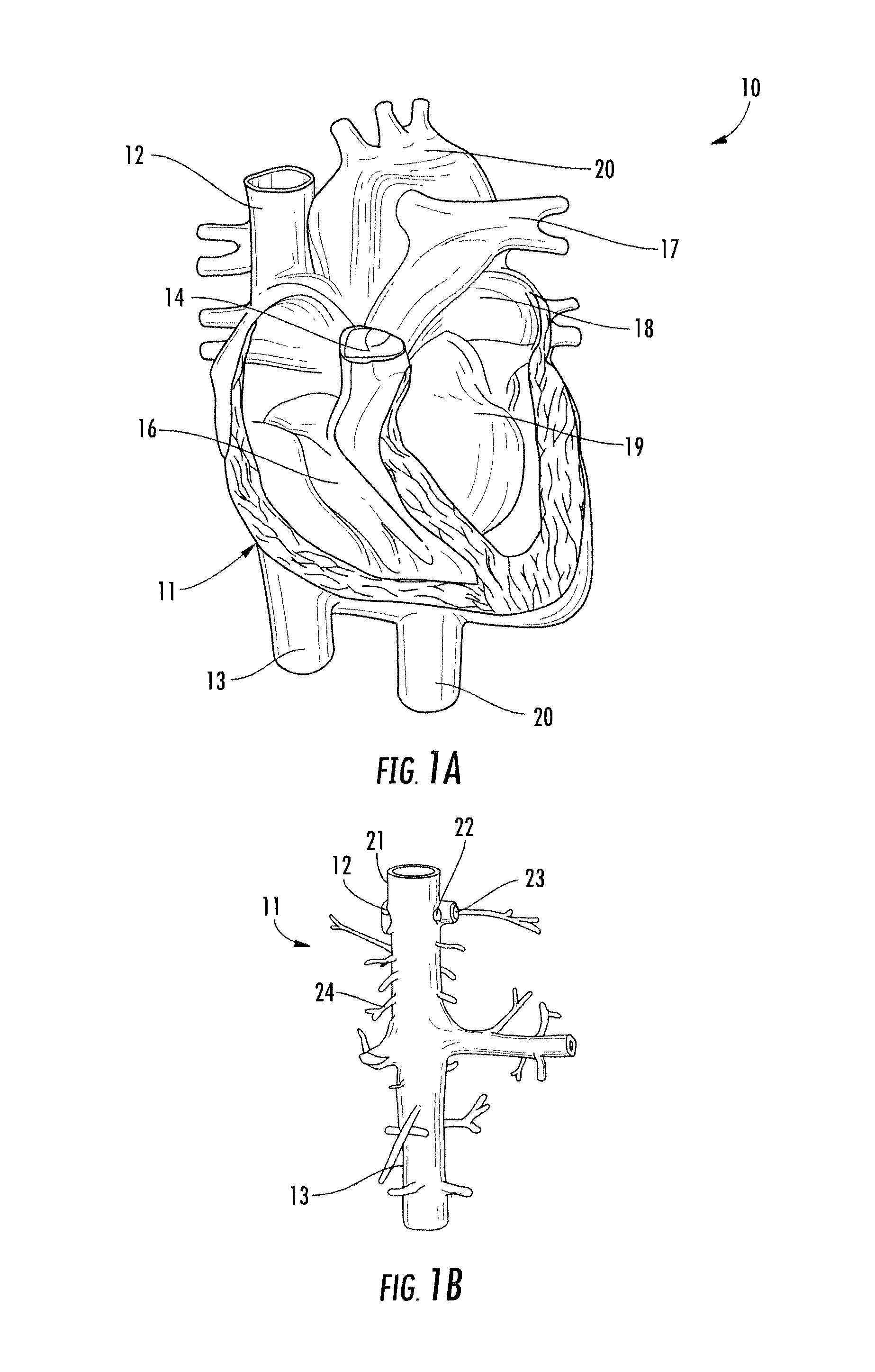 Systems and methods for treating acute and chronic heart failure