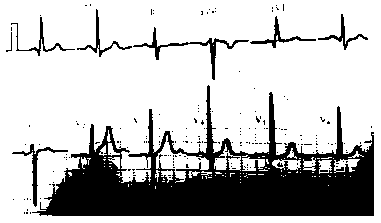 Cardiac electric axis and clockwise transposition measuring tray