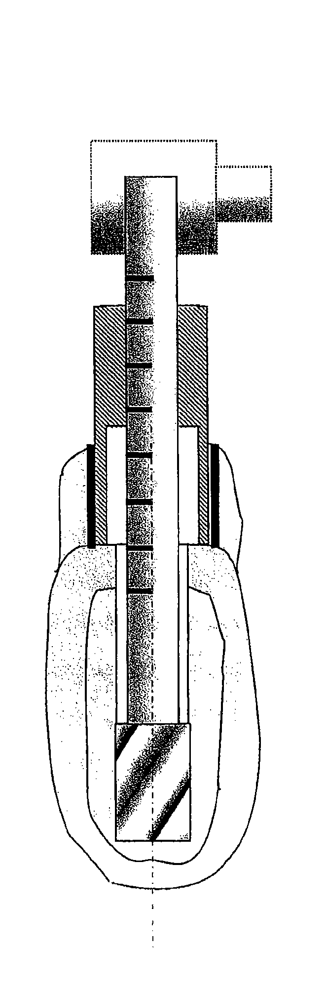 Bone modelling and guide device for preparing bone sites for implant surgery
