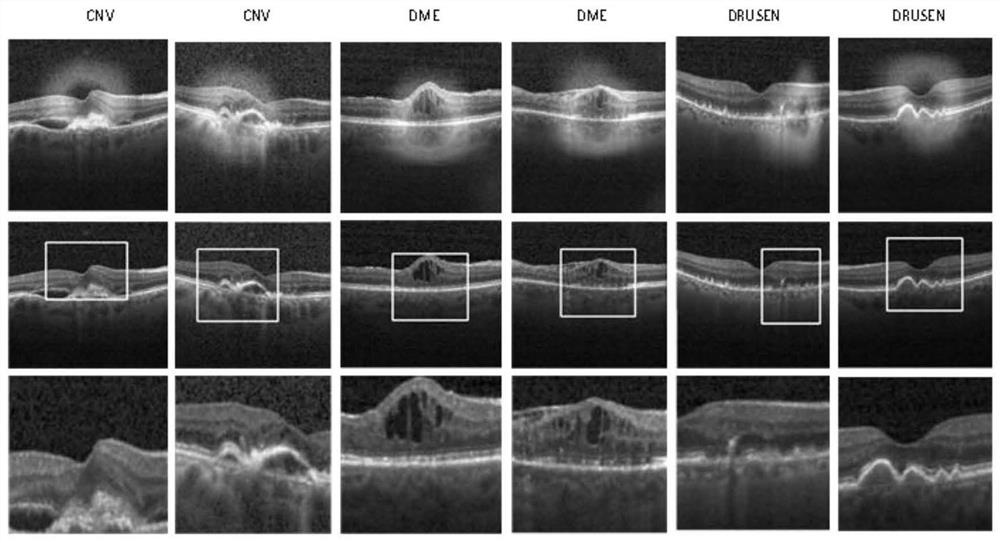 A sd-oct image retinopathy detection system based on class discrimination and localization