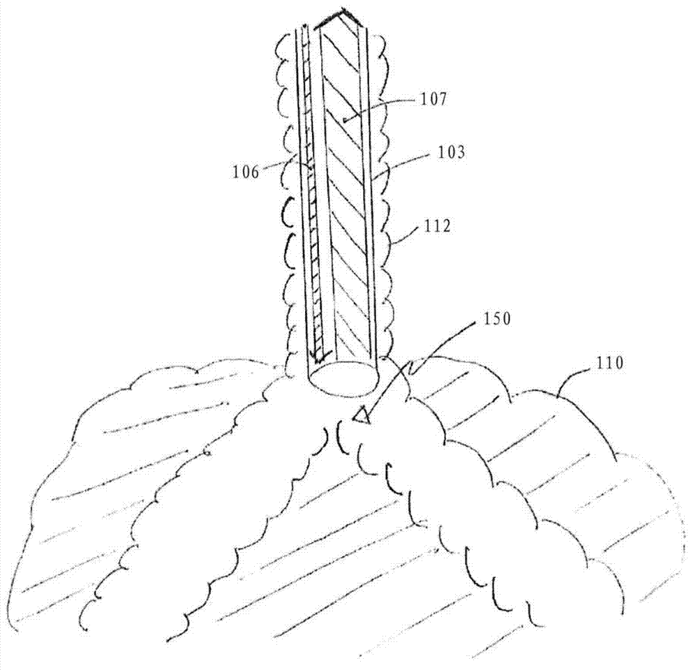 Method and system for patient-synchronized ventilatory assist with endotracheal through-flow