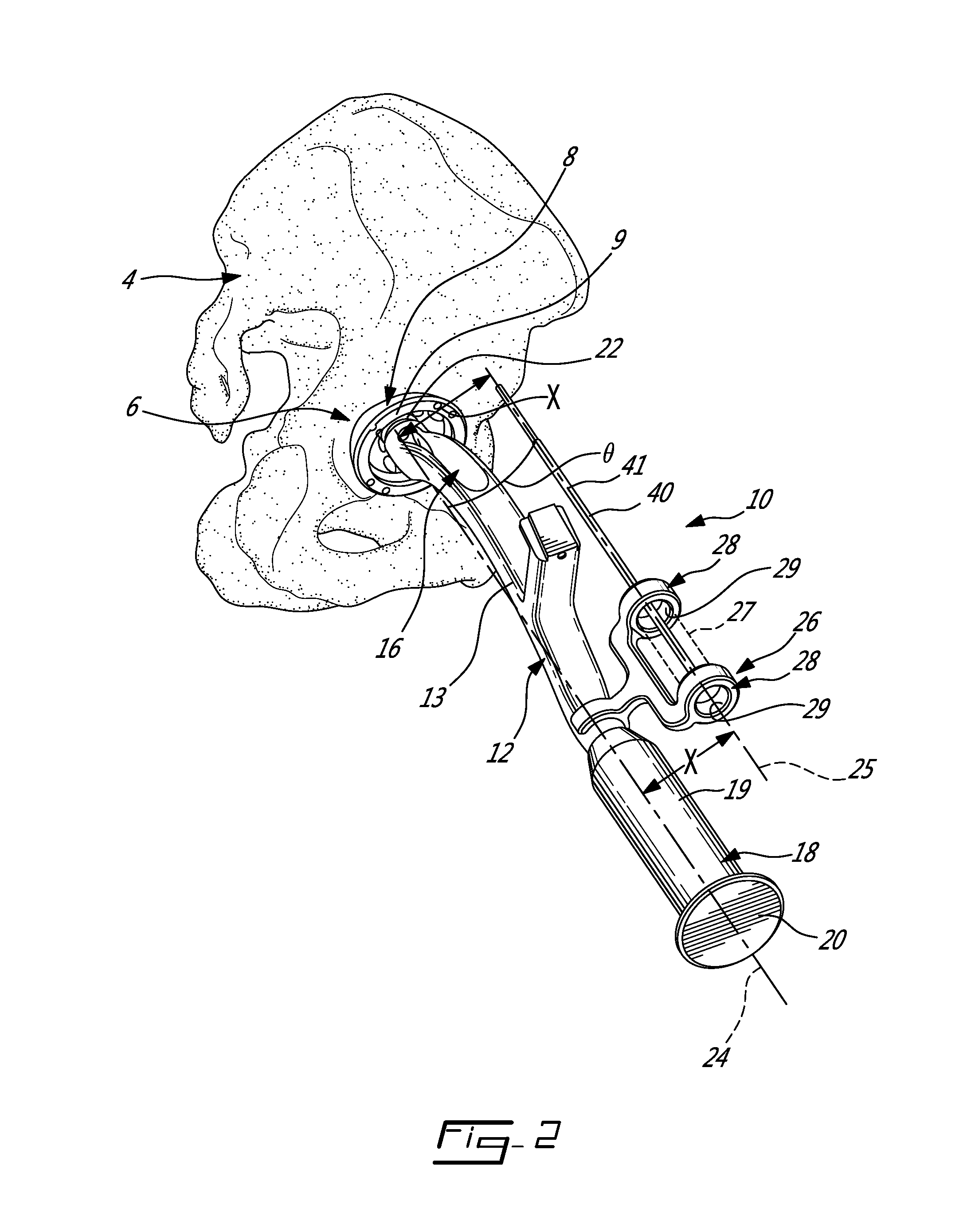 Mechanically guided impactor for hip arthroplasty