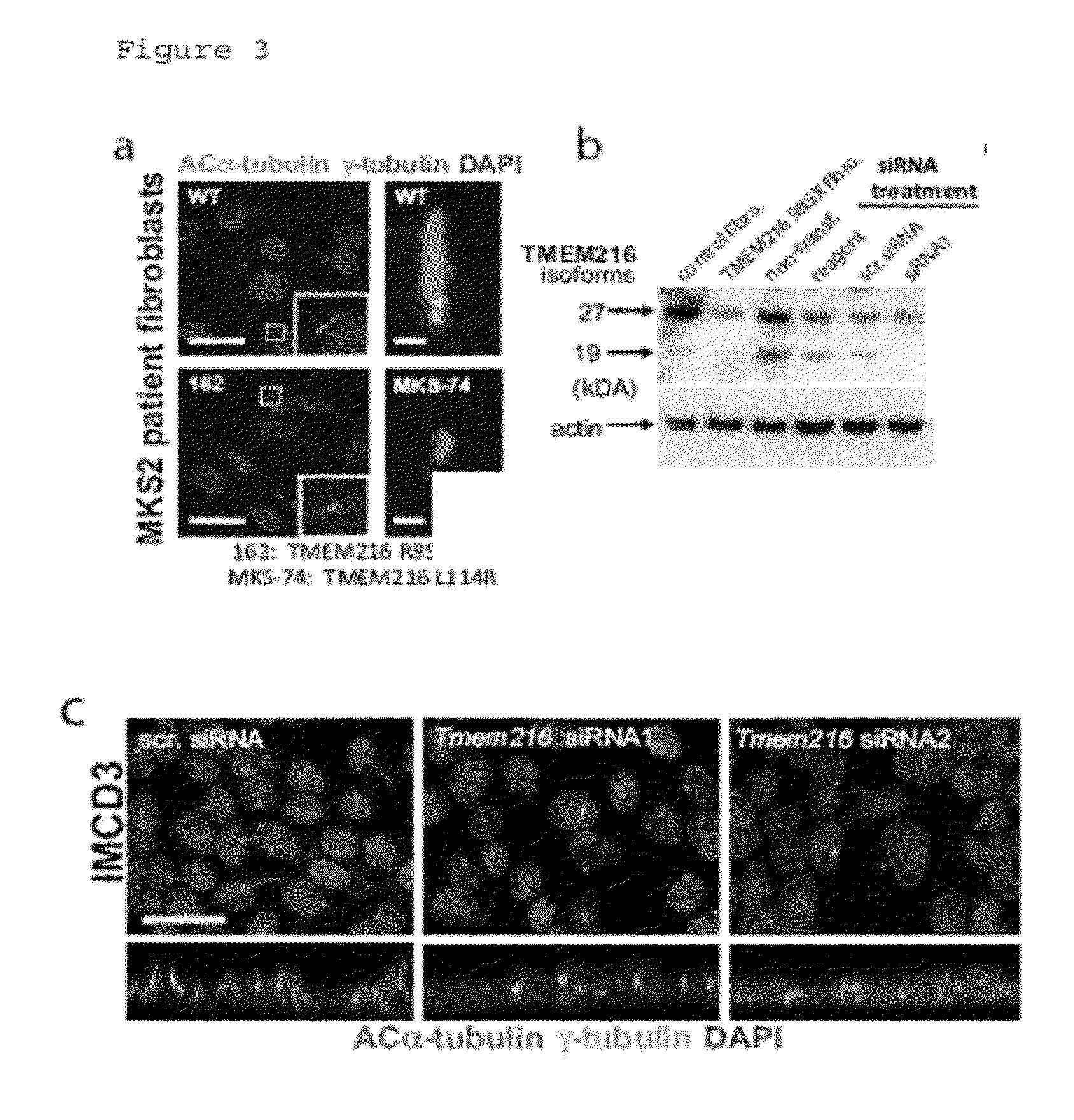 Compositions and methods for determining genetic polymorphisms in the tmem216 gene