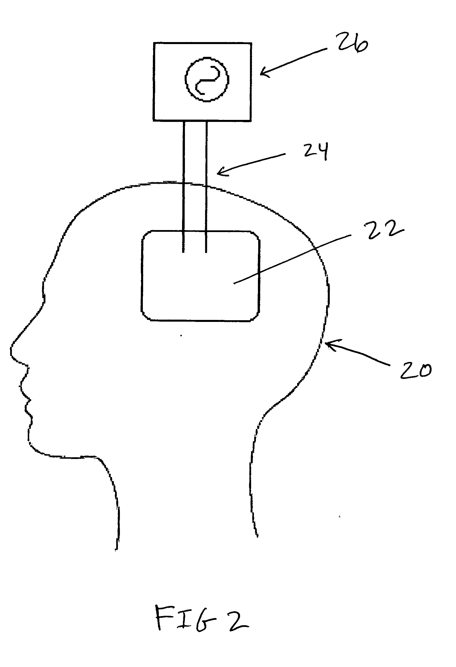 Physiologic stimulation for stroke treatment