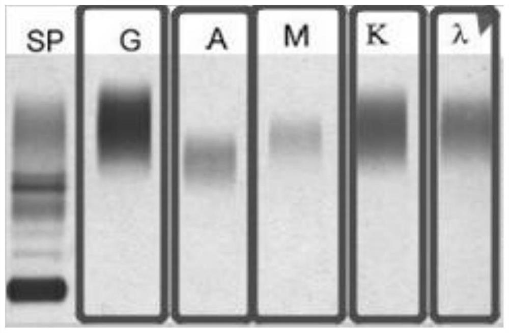 Establishment and application method of an automatic recognition model of immunofixation electrophoresis