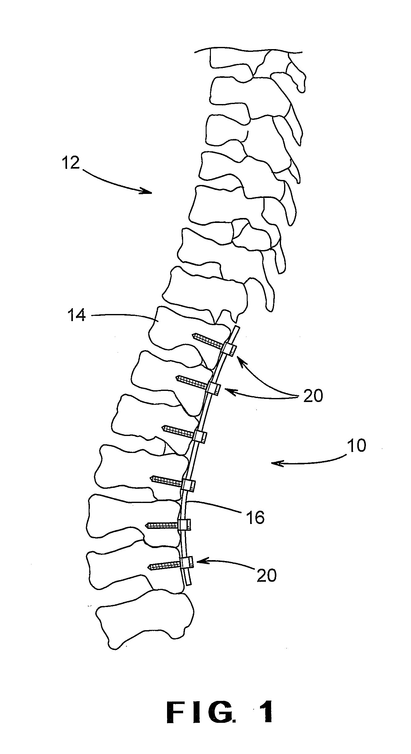 Pedicle screw including stationary and movable members for facilitating the surgical correction of spinal deformities