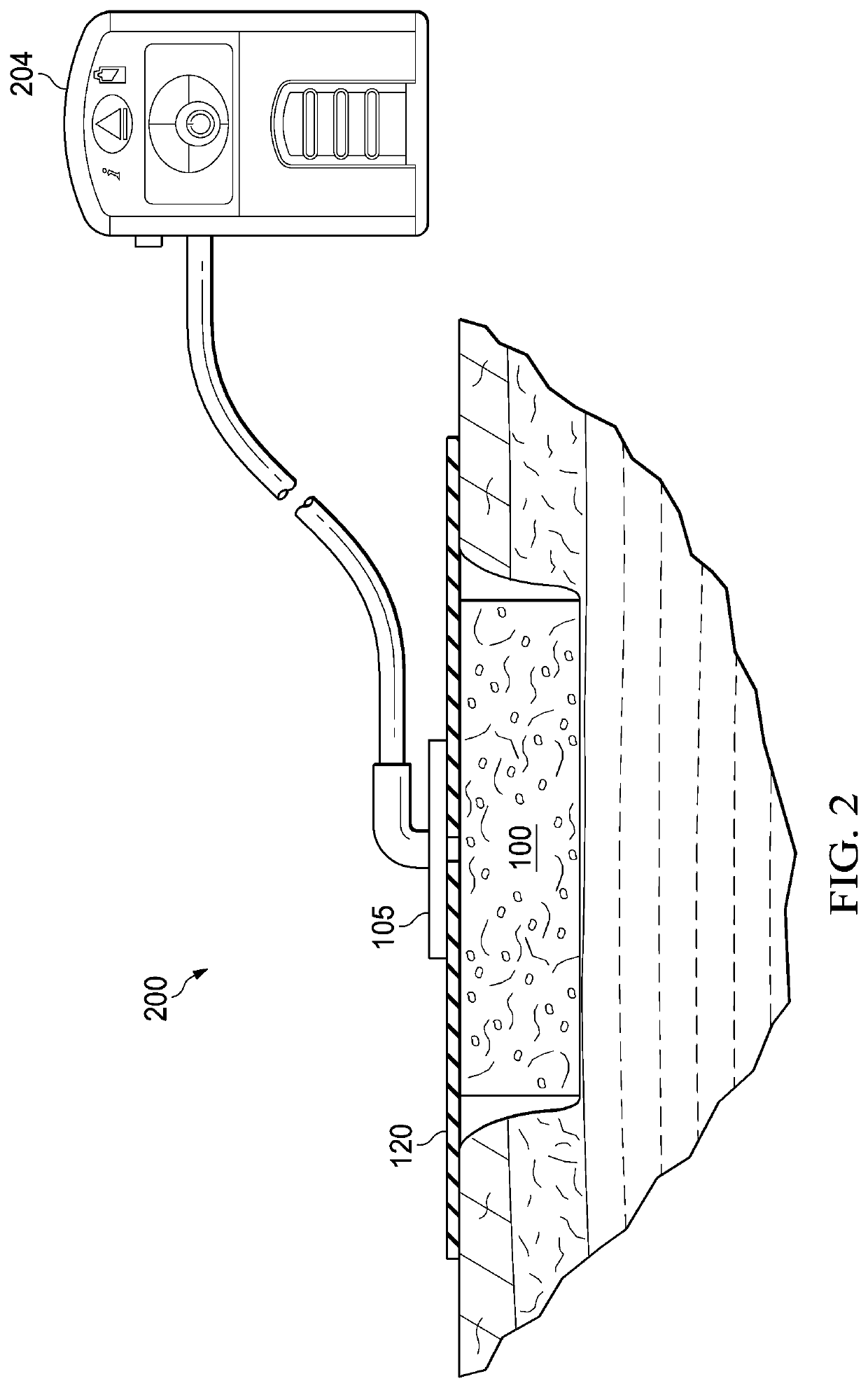 Antimicrobial composition, dressing, dressing components, and method