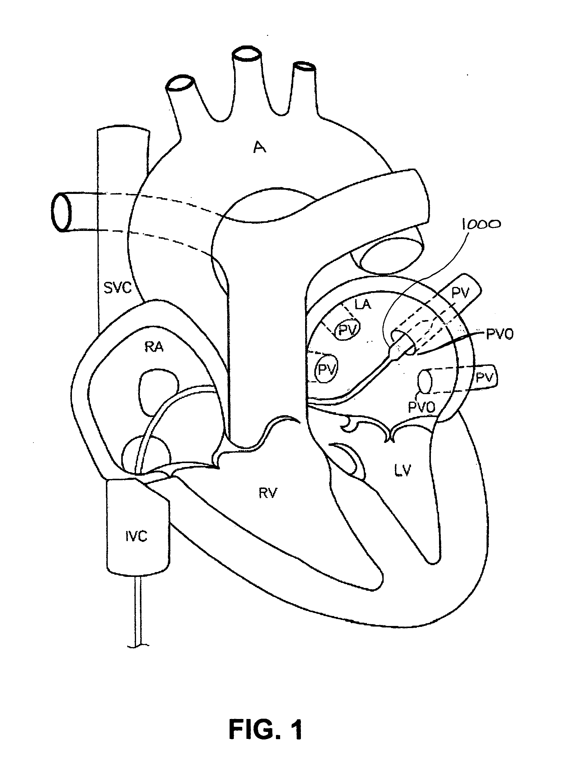 Devices and methods for denervation of the nerves surrounding the pulmonary veins for treatment of atrial fibrillation