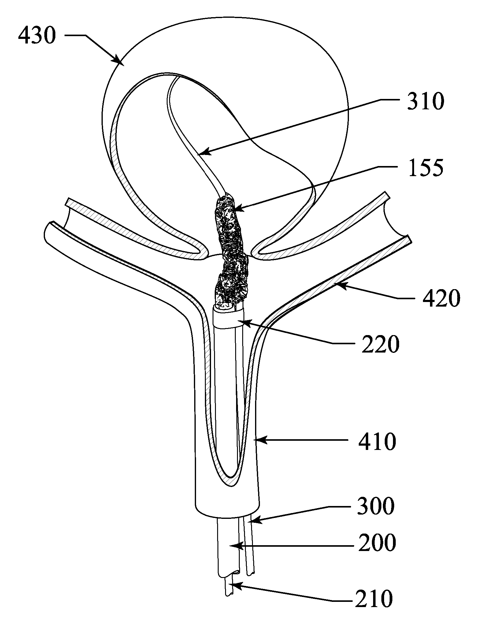 Exclusion Device and System For Delivery