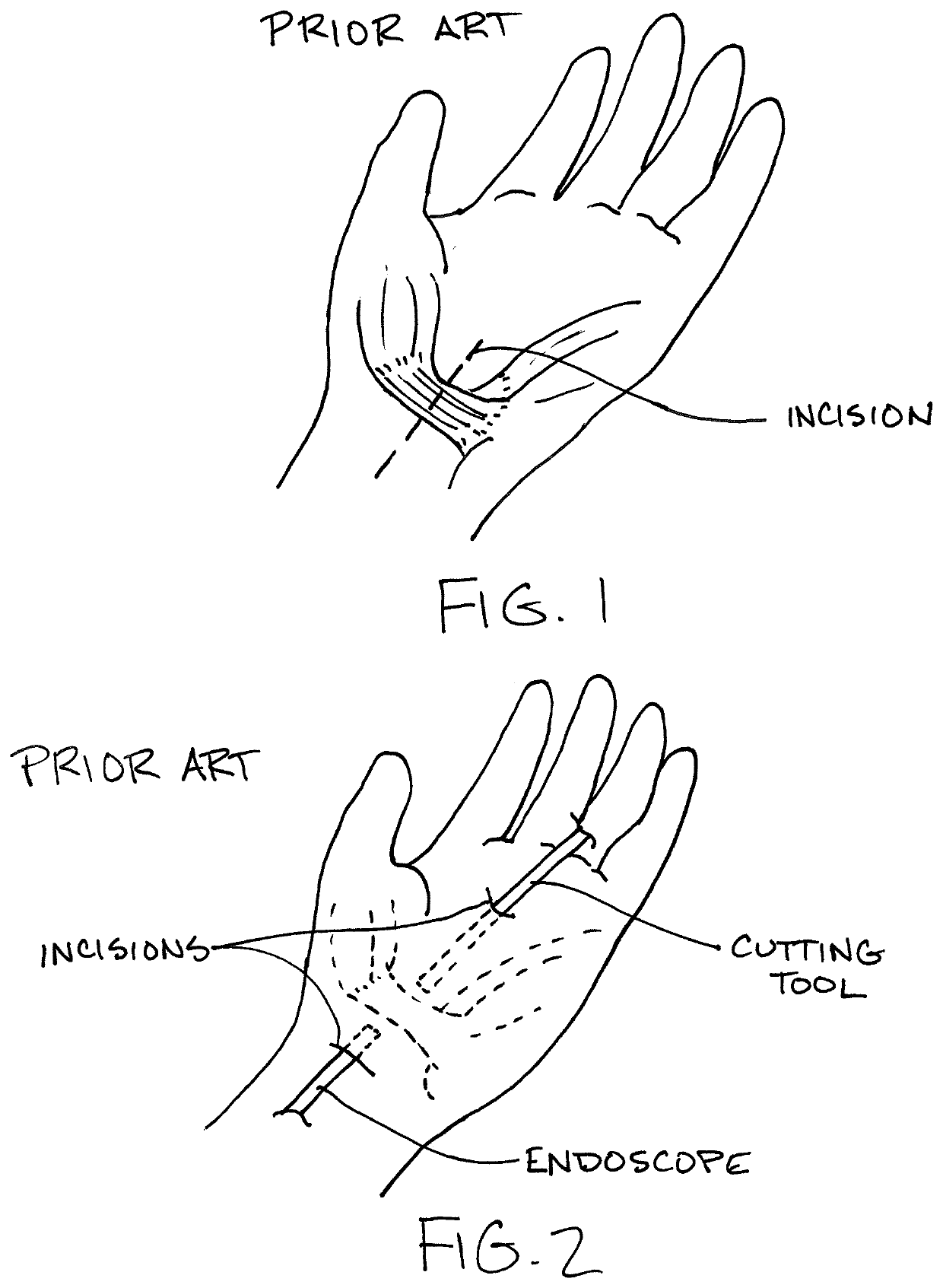 Surgical tool and method of use for carpel tunnel release procedure