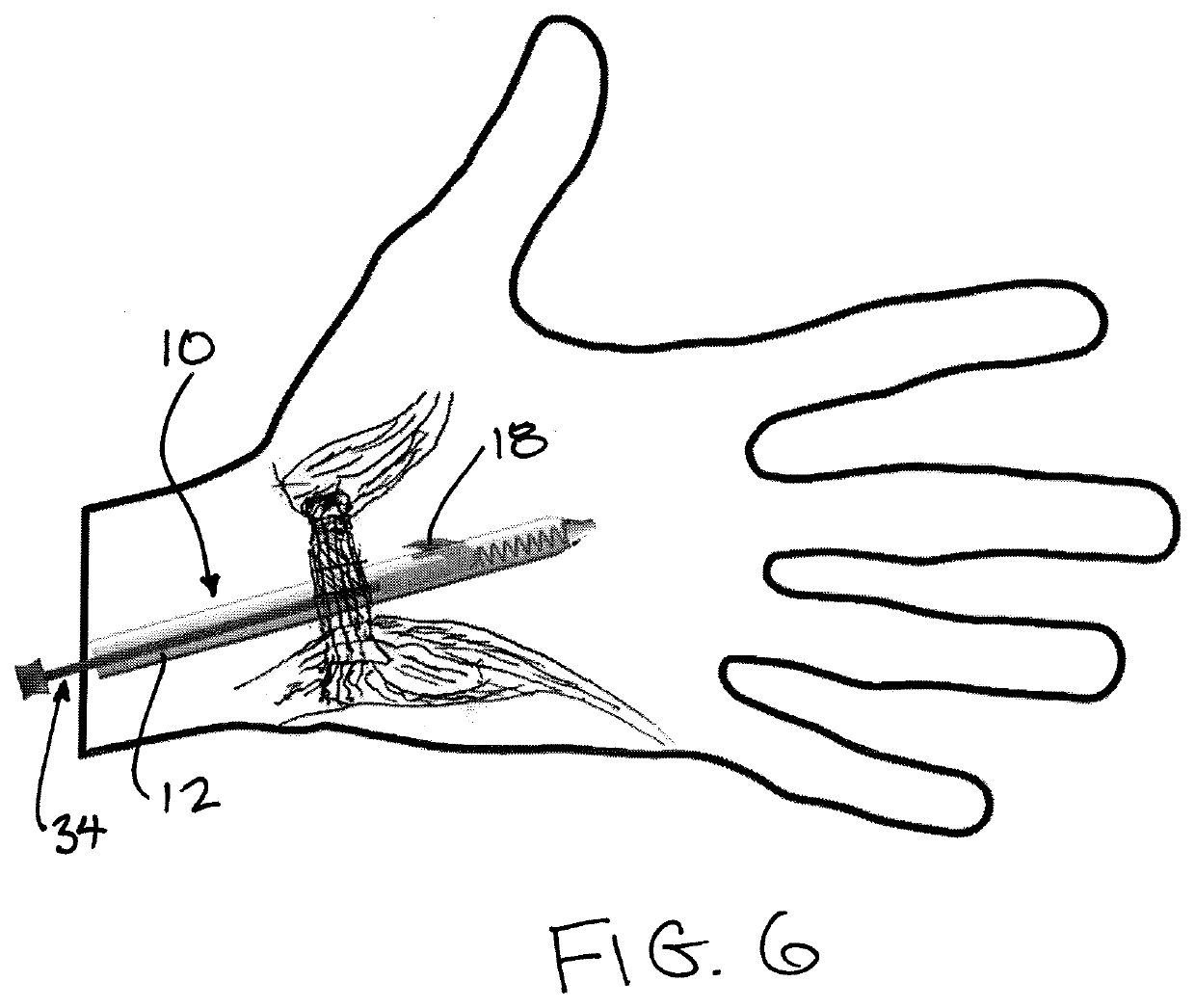Surgical tool and method of use for carpel tunnel release procedure
